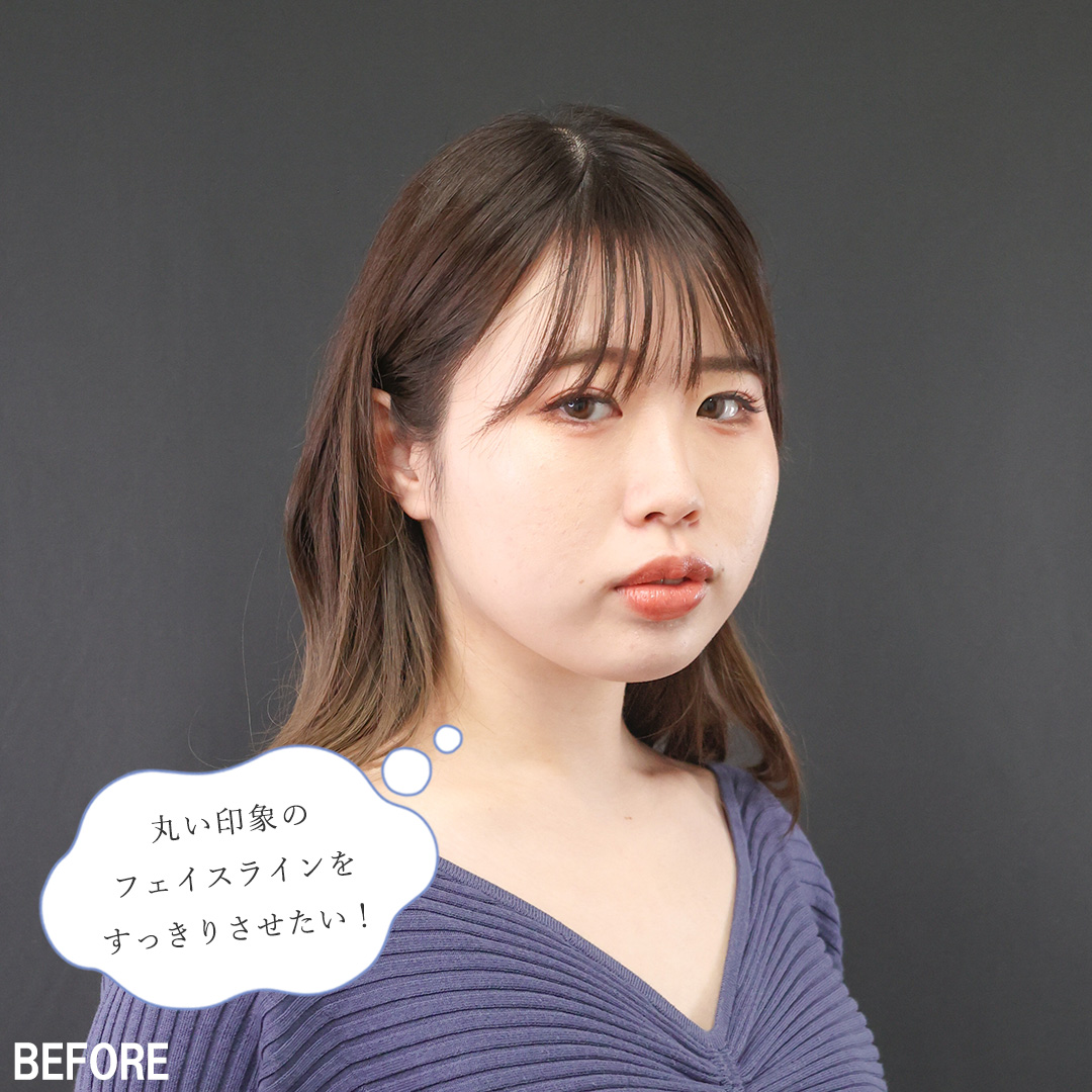 TAC式 ツヤ肌コラーゲンリフト®/バッカルファット除去/Lラインファット除去(エラ下脂肪除去)の症例写真 施術前後