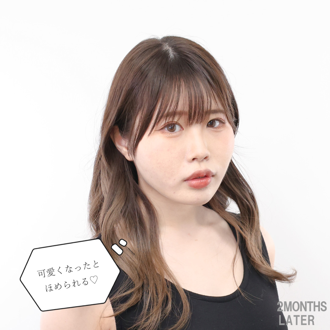 TAC式 ツヤ肌コラーゲンリフト®/バッカルファット除去/Lラインファット除去(エラ下脂肪除去)の症例写真 施術前後