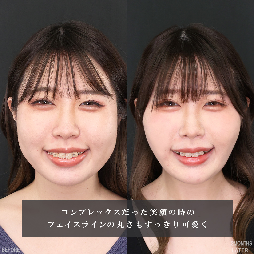 TAC式 ツヤ肌コラーゲンリフト®/バッカルファット除去/Lラインファット除去(エラ下脂肪除去)の症例写真 施術前後