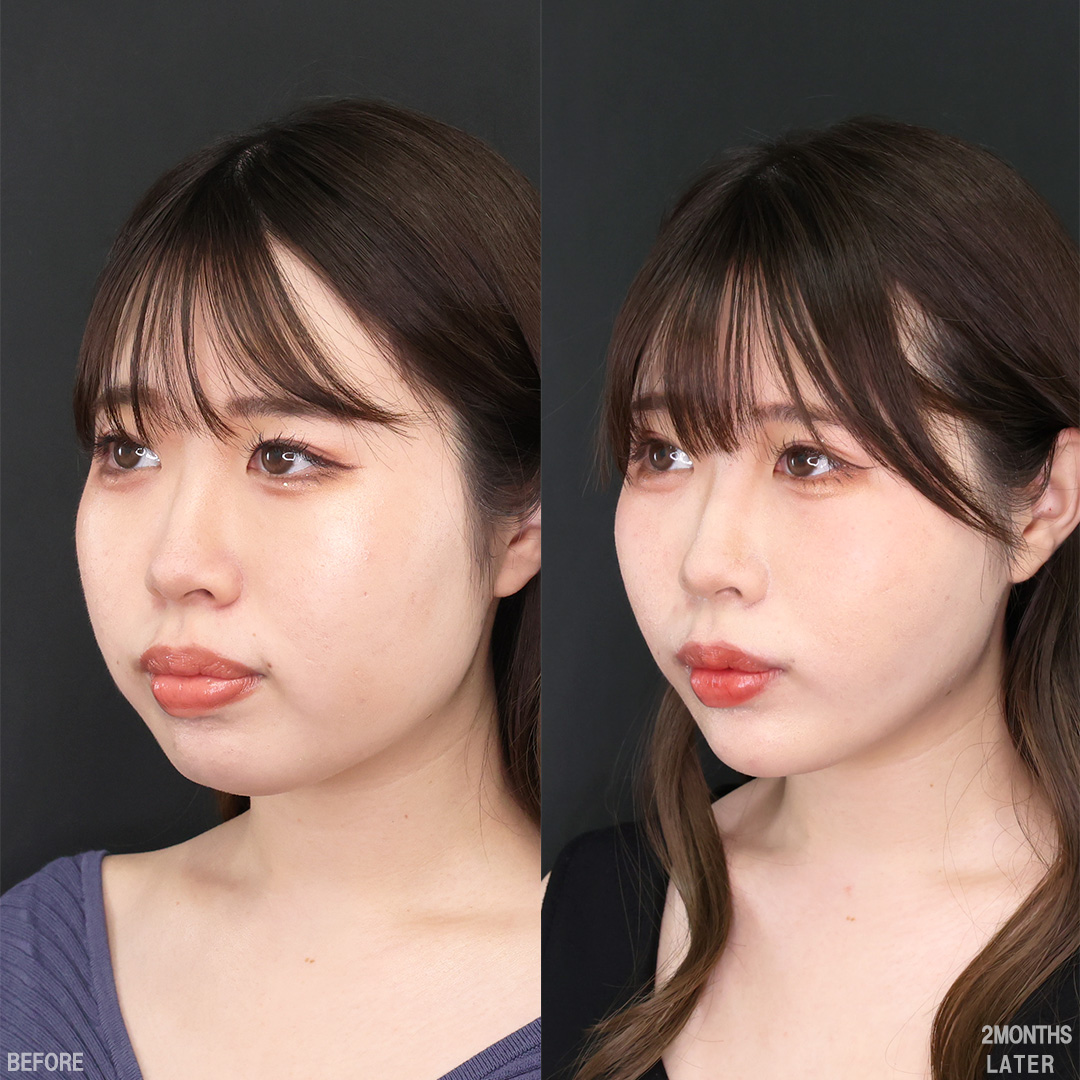 TAC式 ツヤ肌コラーゲンリフト®/バッカルファット除去/Lラインファット除去(エラ下脂肪除去)の症例写真 施術前後