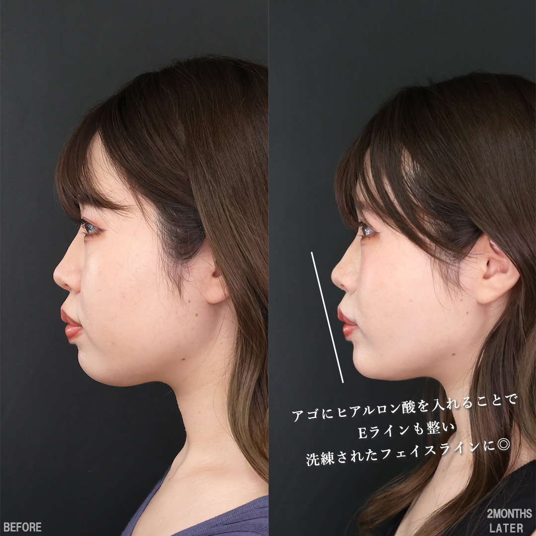 TAC式 ツヤ肌コラーゲンリフト®/バッカルファット除去/Lラインファット除去(エラ下脂肪除去)の症例写真 施術前後