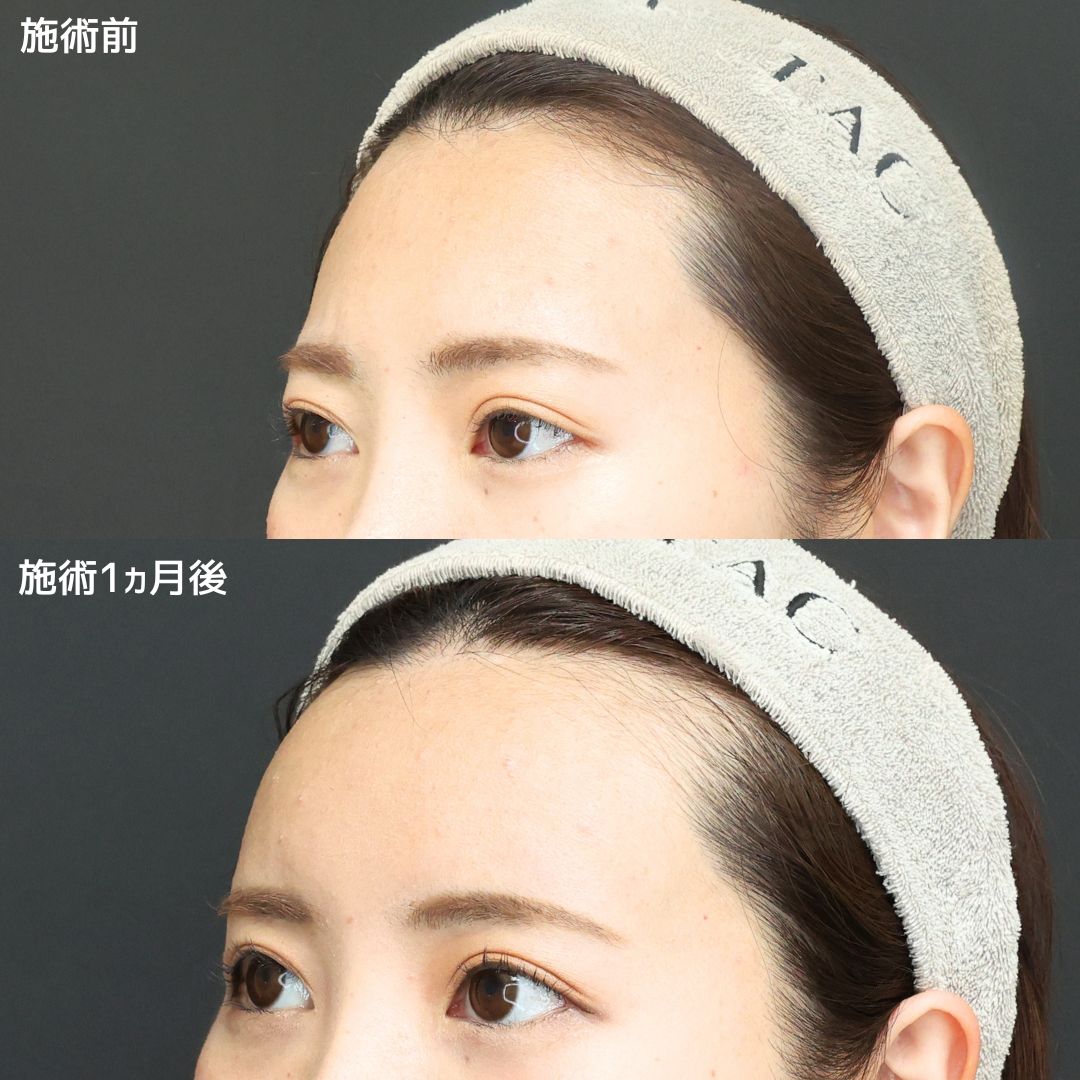 《脂肪注入》で美しいS字カーブ誕生