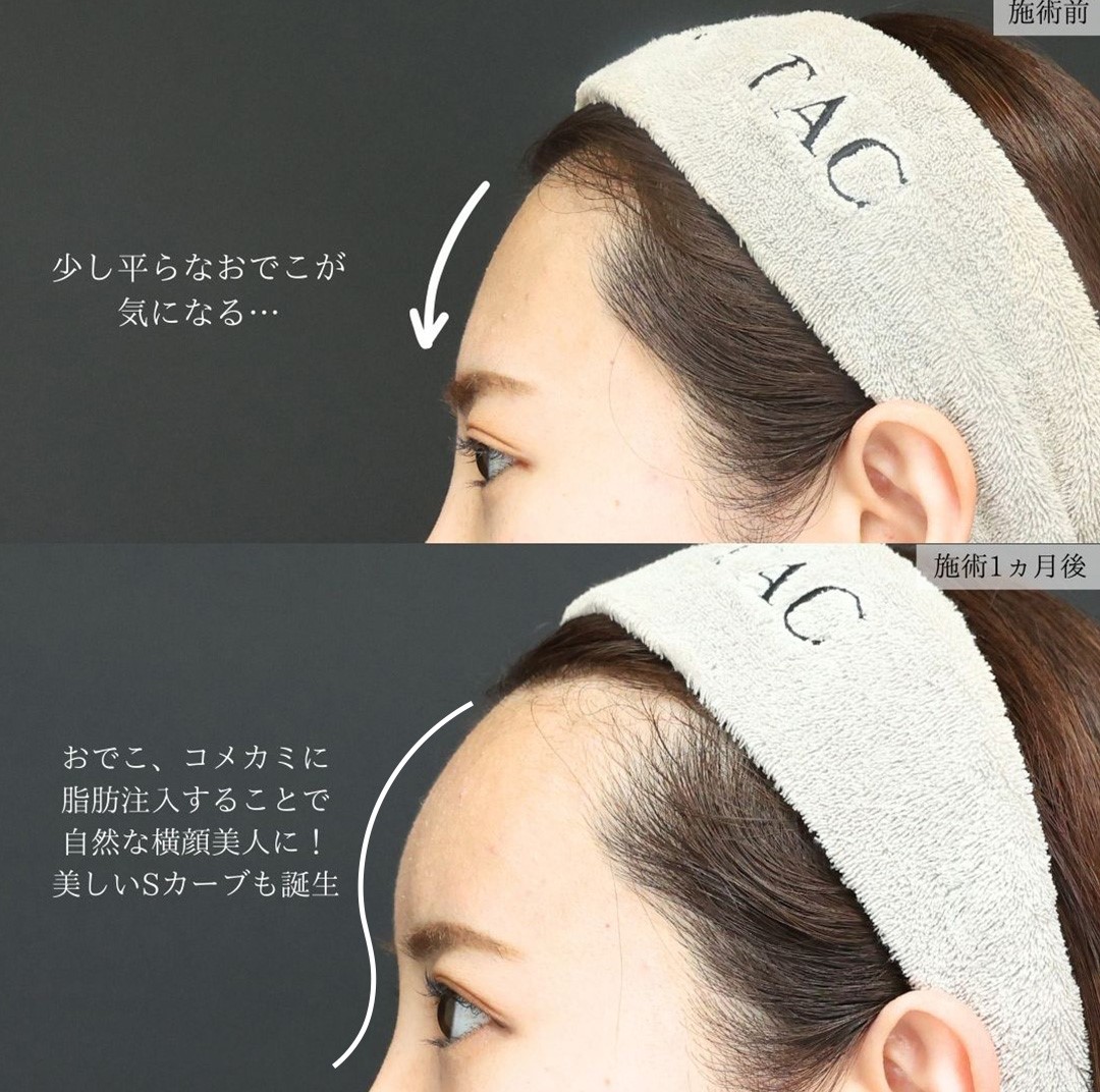 おでこの脂肪注入（オルチャンデコ形成）/ボトックス注射：その他の症例写真 施術前後 