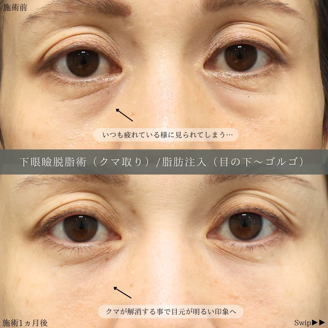 下眼瞼脱脂術（目の下のたるみ取り・目の下の脂肪ふくらみ取り）の症例写真 施術前後 