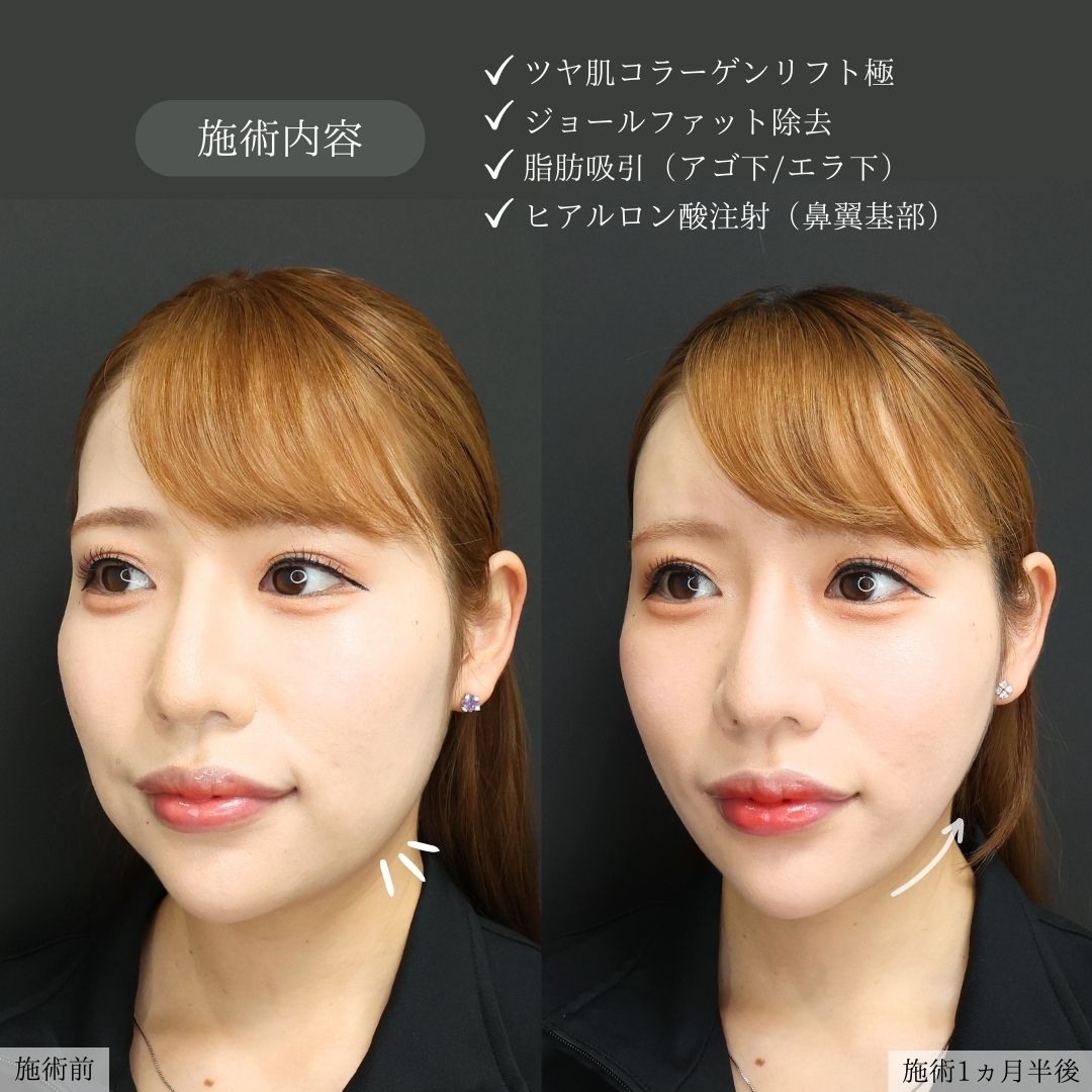 TAC式 ツヤ肌コラーゲンリフト®/ジョールファット除去/顎下の脂肪吸引の症例写真 施術前後 