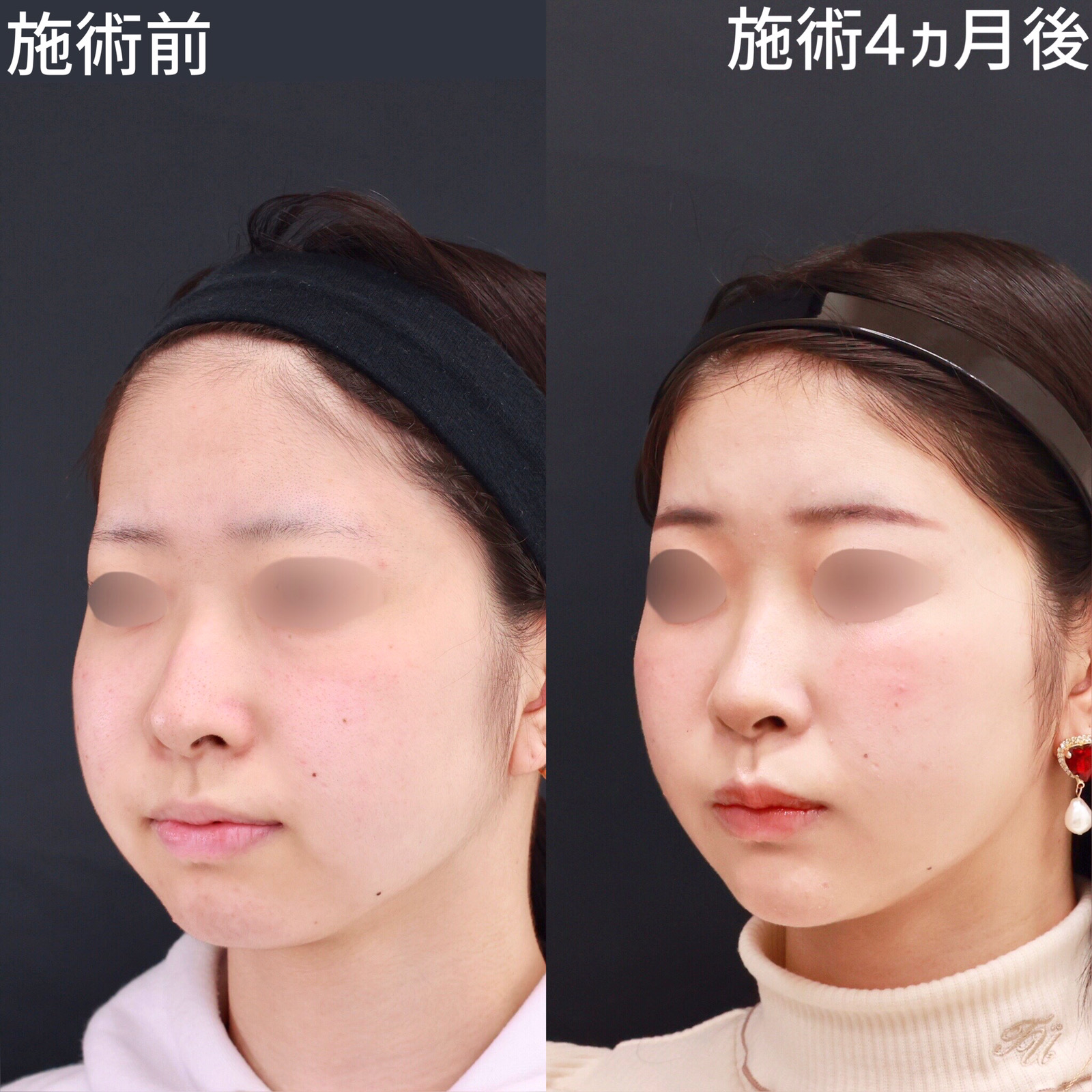 【糸リフト×脂肪除去】お顔の厚みが減ってスッキリ小顔に！