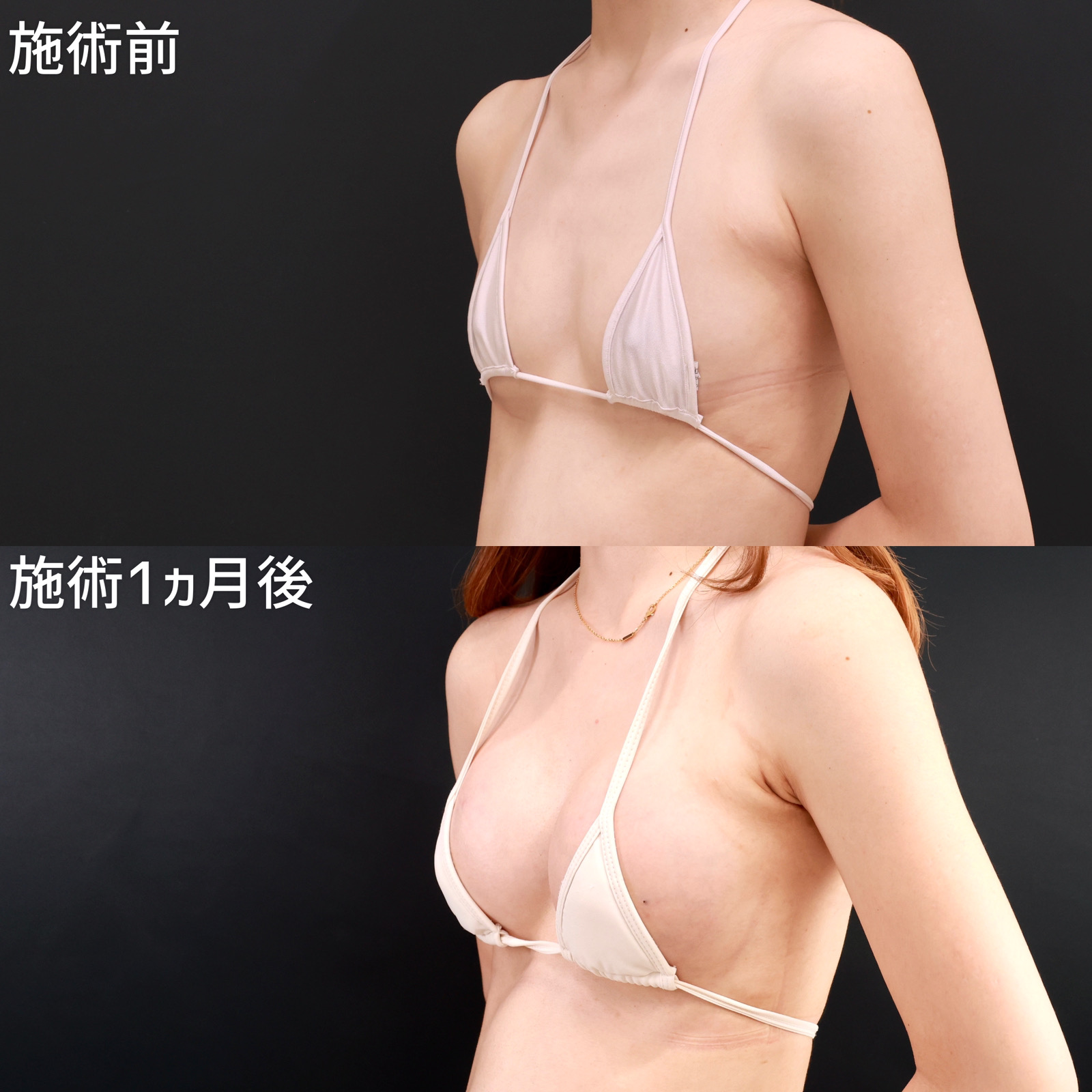 【シリコンバッグ豊胸】痩せ型の方も確実にバストアップ!