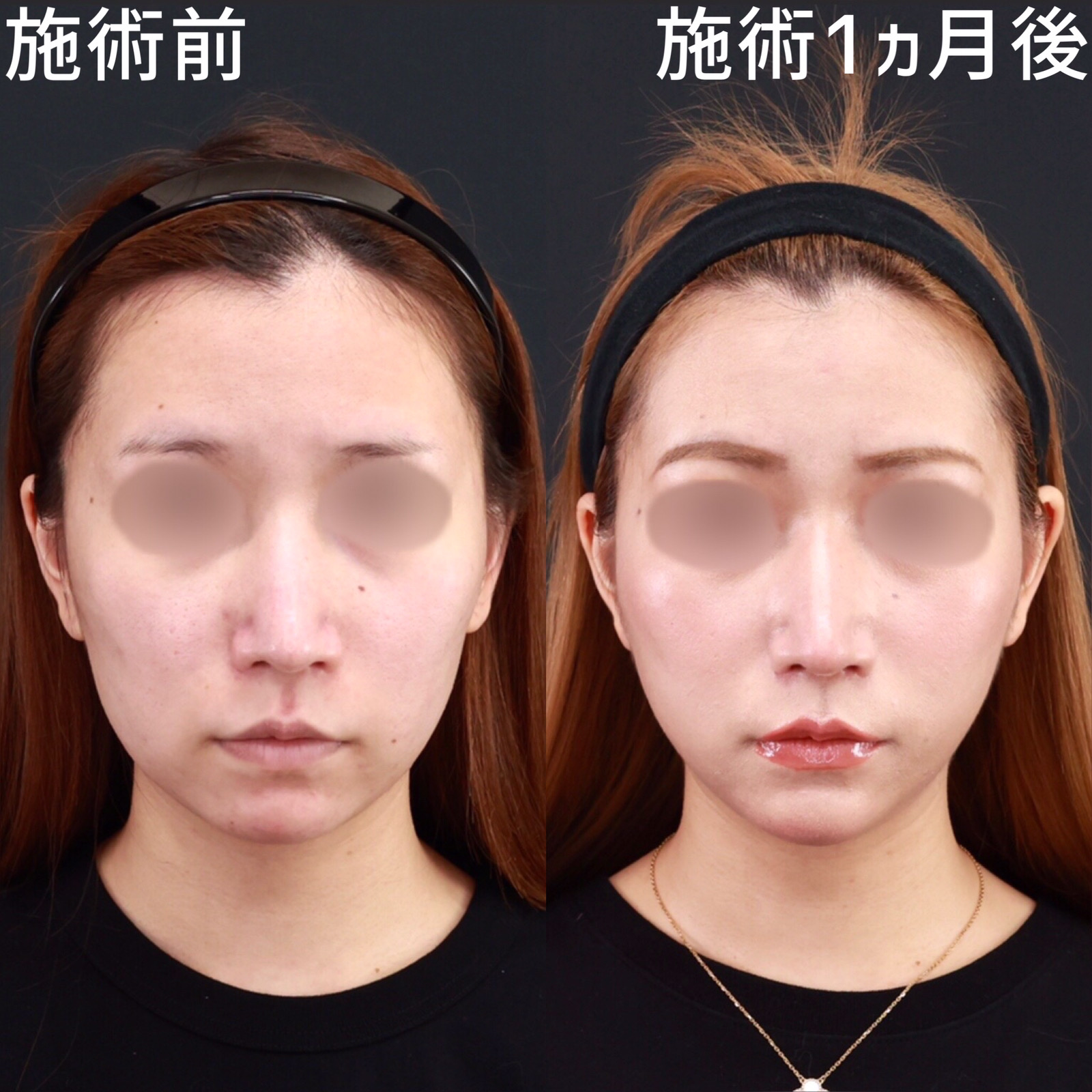 【糸リフト×ジョールファット除去】口元のもたつきを取り除く！