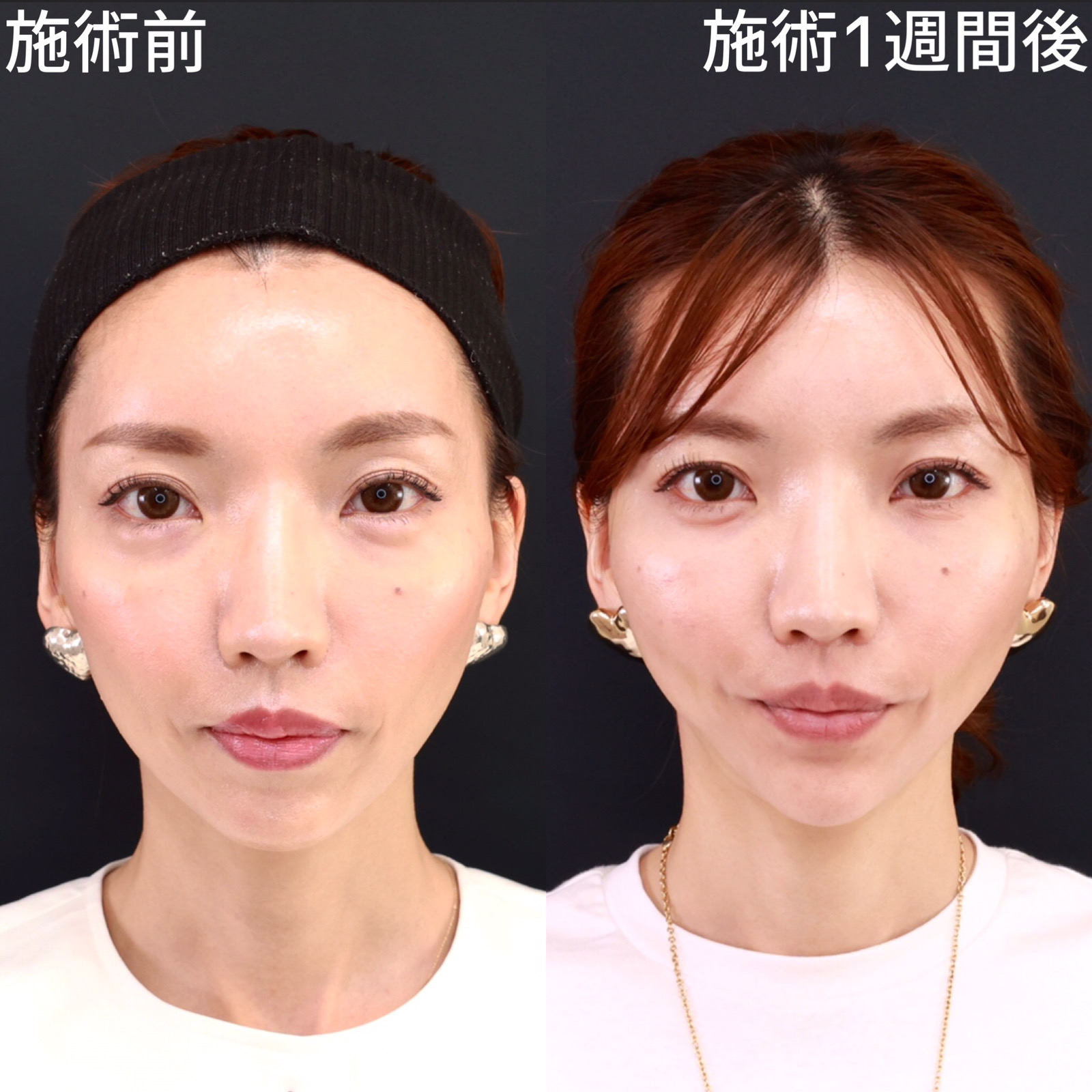 【糸リフト×ヒアルロン酸注射】ブルドッグ顔を予防する！