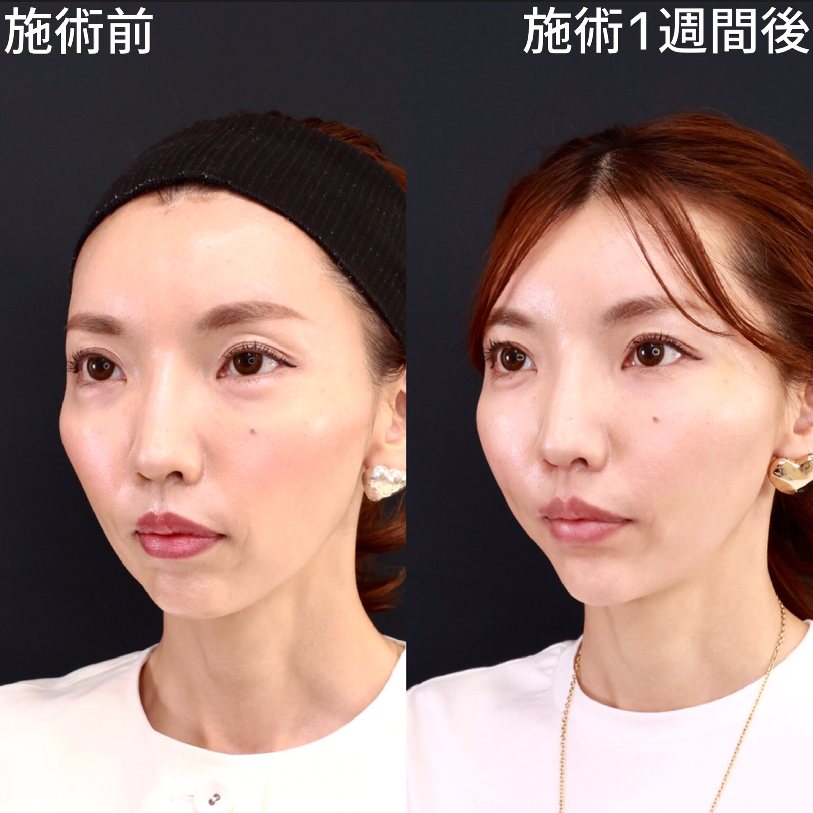 TAC式 ツヤ肌コラーゲンリフト®/顎のヒアルロン酸注射の症例写真 施術前後 