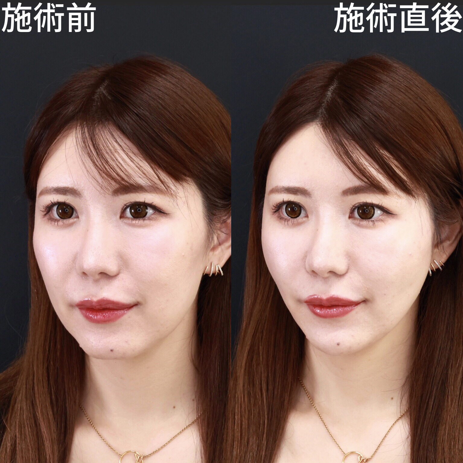 TAC式 ツヤ肌コラーゲンリフト®/顎のヒアルロン酸注射/ほうれい線のヒアルロン酸注射の症例写真 施術前後