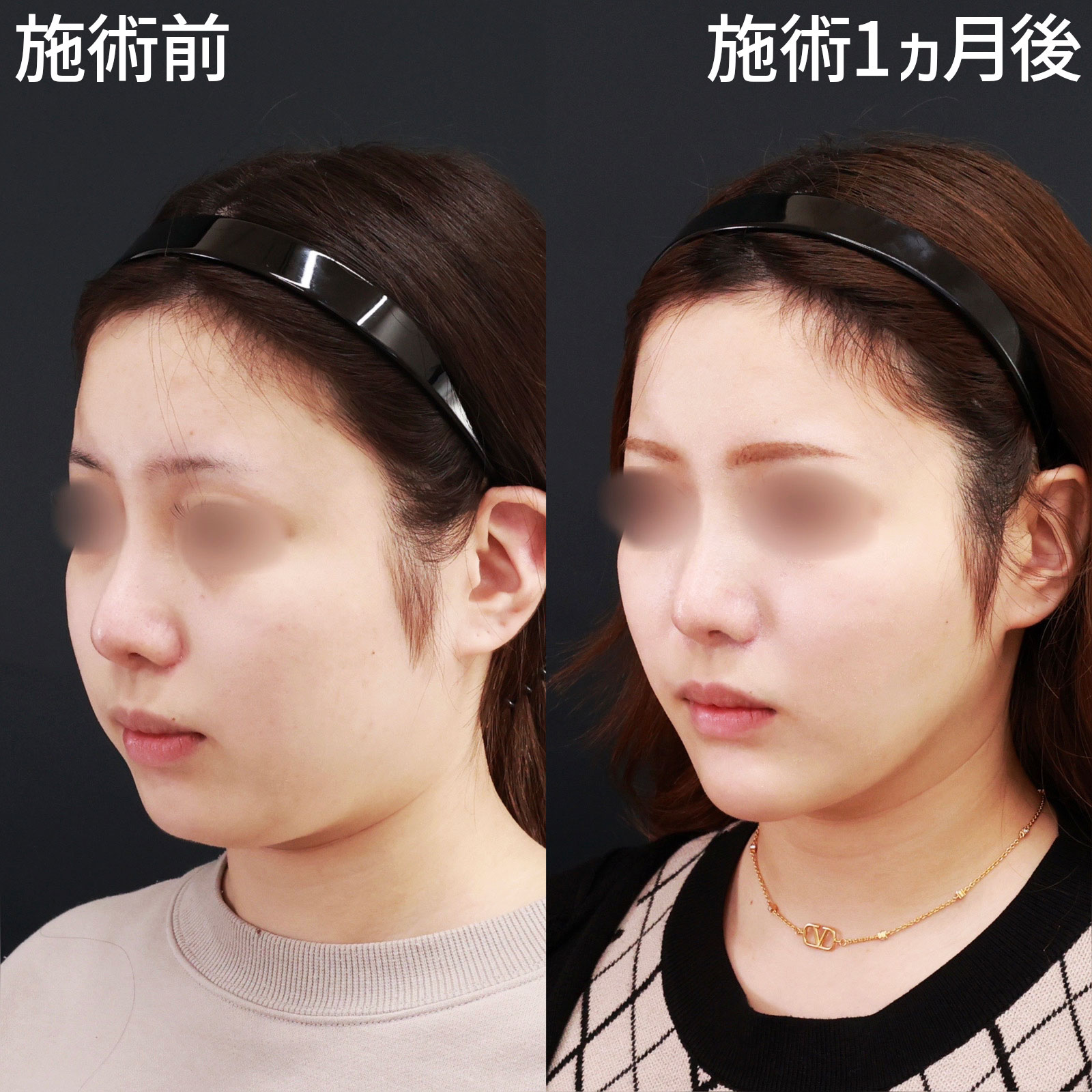 バッカルファット除去/ジョールファット除去/小顔整形｜パーフェクトフェイスラインの症例写真 施術前後 