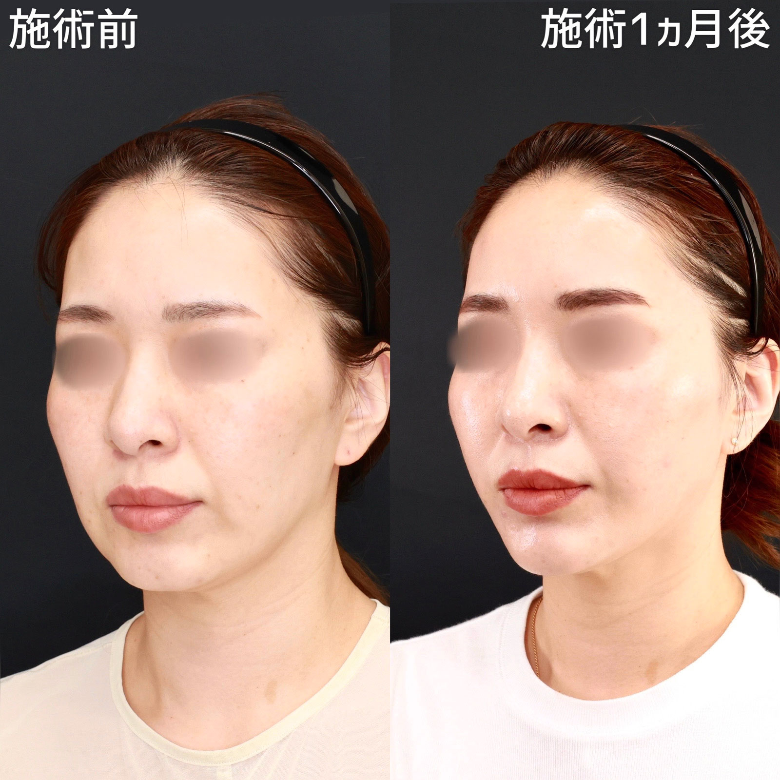 【糸リフト×脂肪除去】口周りのもたつきを無くしてナチュラルな卵型の輪郭に！