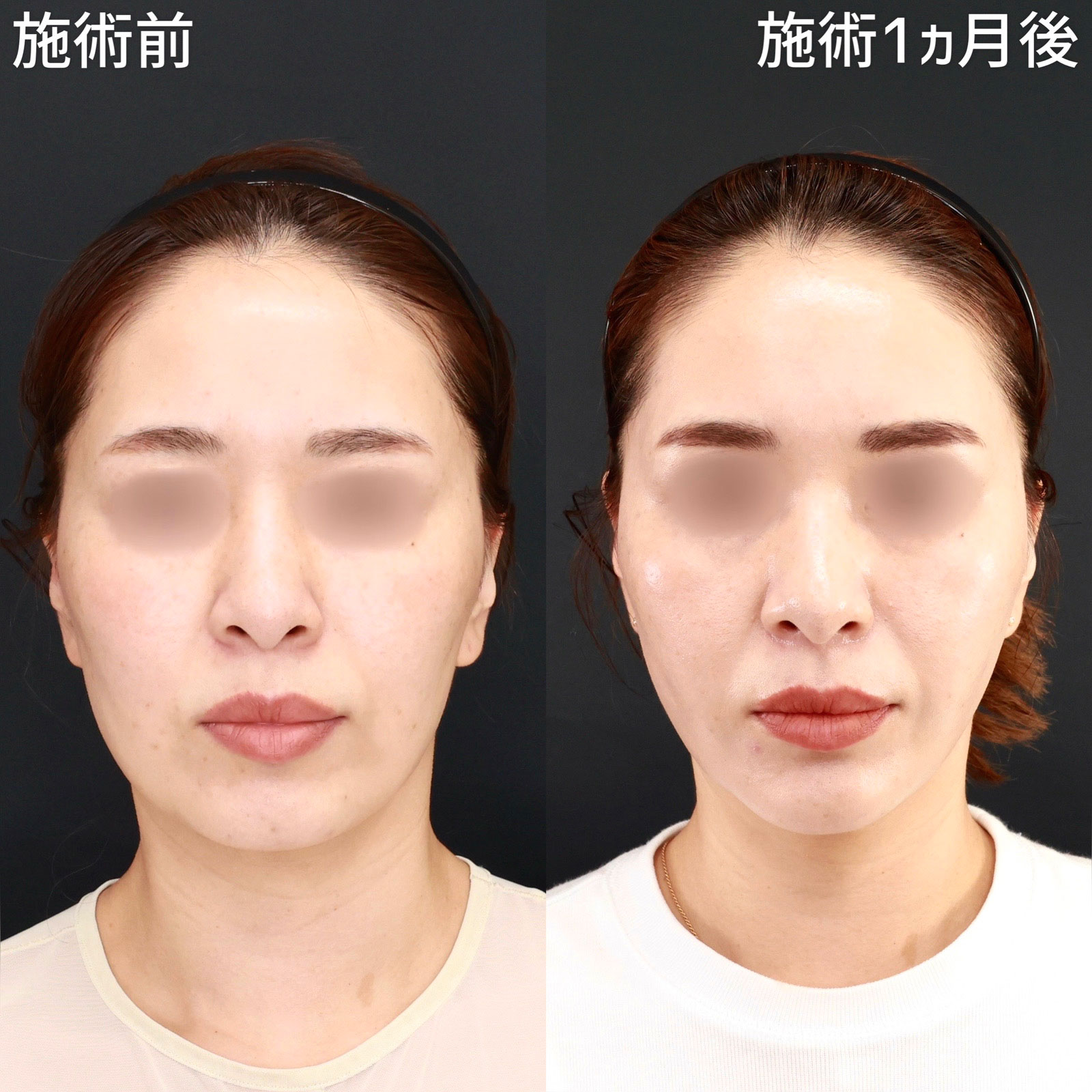 小顔整形｜パーフェクトフェイスライン/ジョールファット除去/エラボトックス注射の症例写真 施術前後 