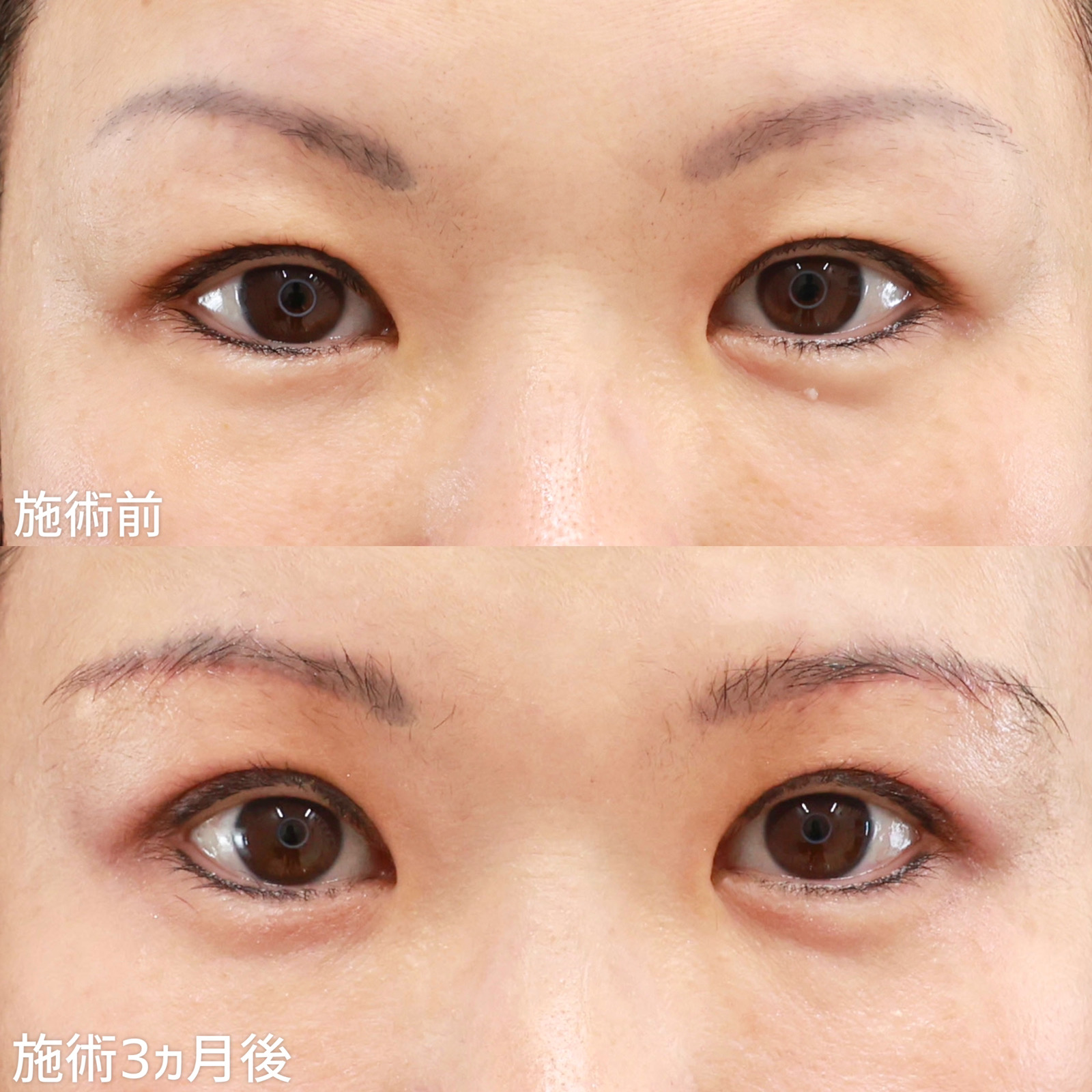【眉毛下切開】目のカタチと眉毛とのバランスも整えて、優しい印象の目元に！