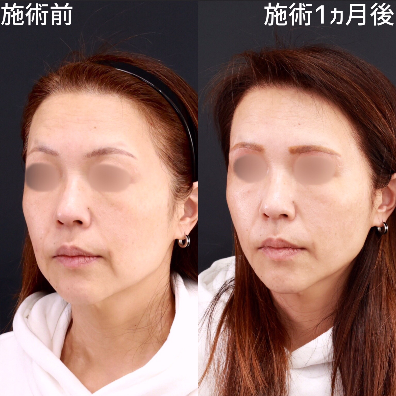 【糸リフト×ジョールファット除去】たるみ除去でアンチエイジング！