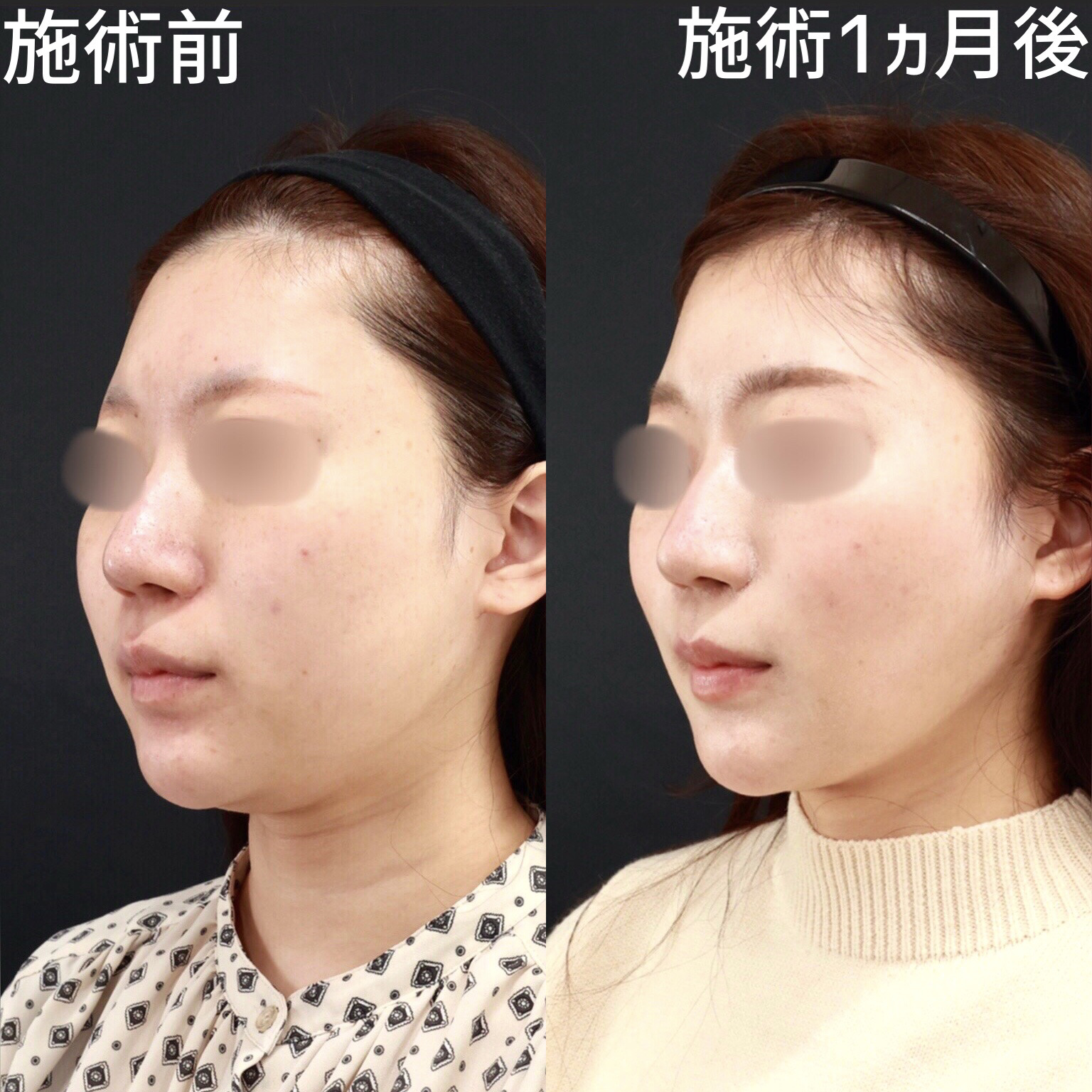 【糸リフト×脂肪除去】お顔がボリュームダウンし二重顎改善！