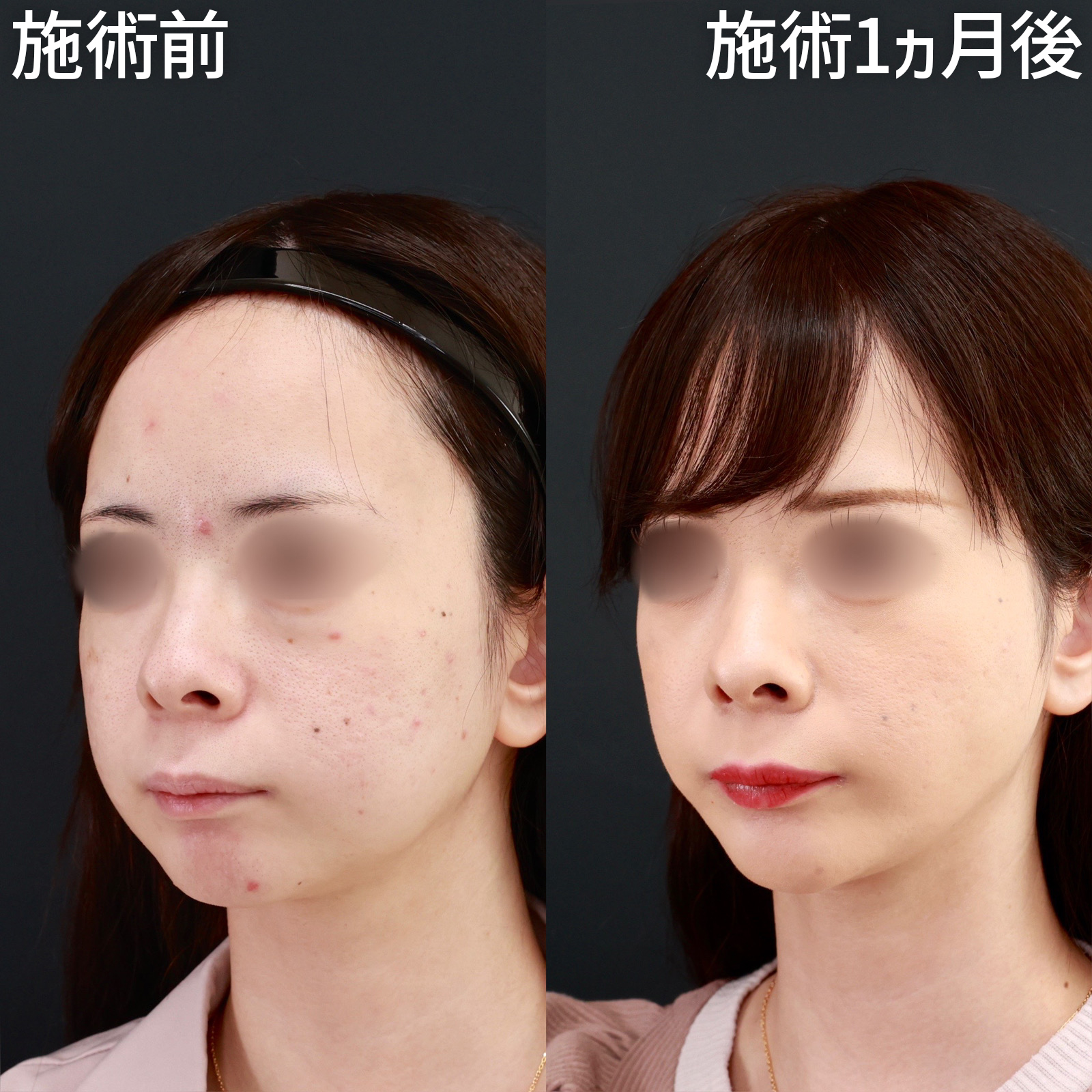 小顔整形｜パーフェクトフェイスライン/バッカルファット除去/エラボトックス注射の症例写真 施術前後 