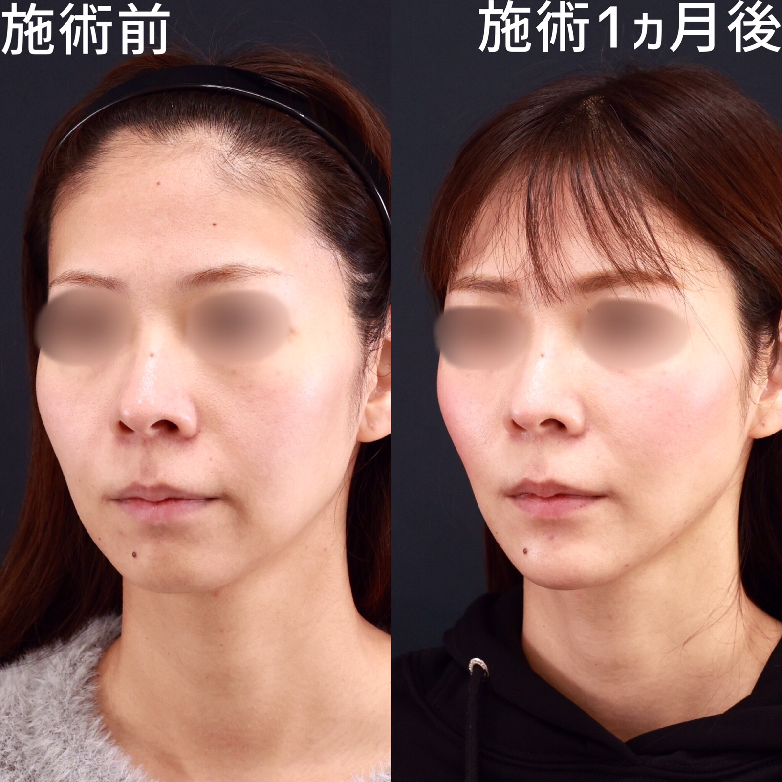 【糸リフト×ヒアルロン酸】シャープな輪郭を形成！