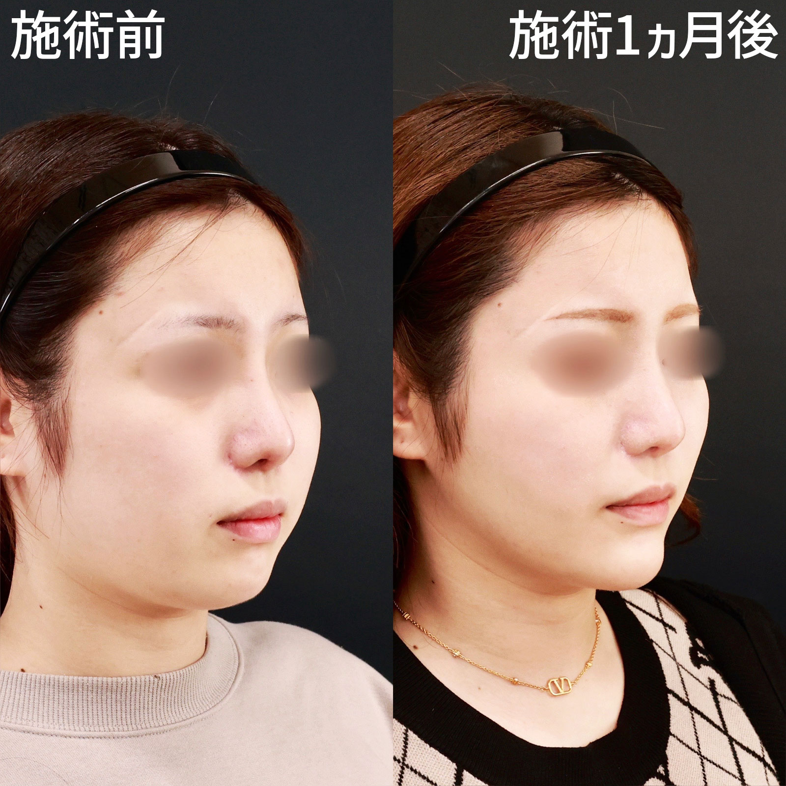 バッカルファット除去/ジョールファット除去/小顔整形｜パーフェクトフェイスラインの症例写真 施術前後 