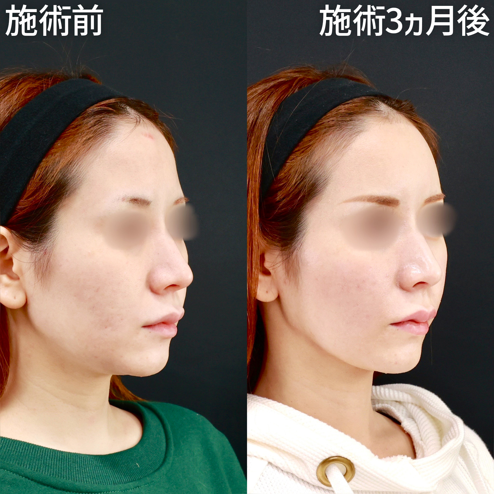 ジョールファット除去/TAC式 ツヤ肌コラーゲンリフト®/顎下の脂肪吸引の症例写真 施術前後 