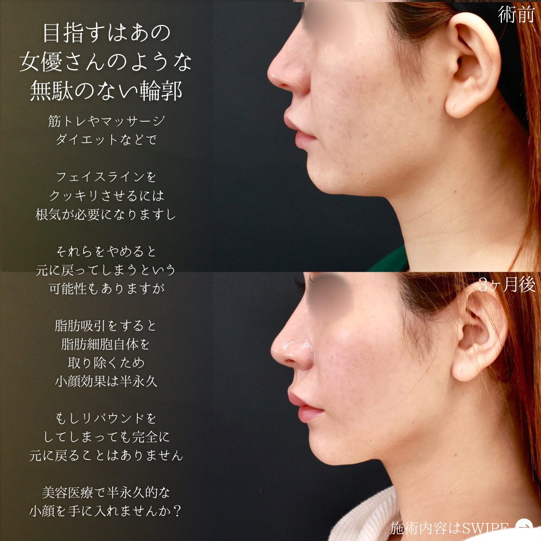 ジョールファット除去/TAC式 ツヤ肌コラーゲンリフト®/顎下の脂肪吸引の症例写真 施術前後 