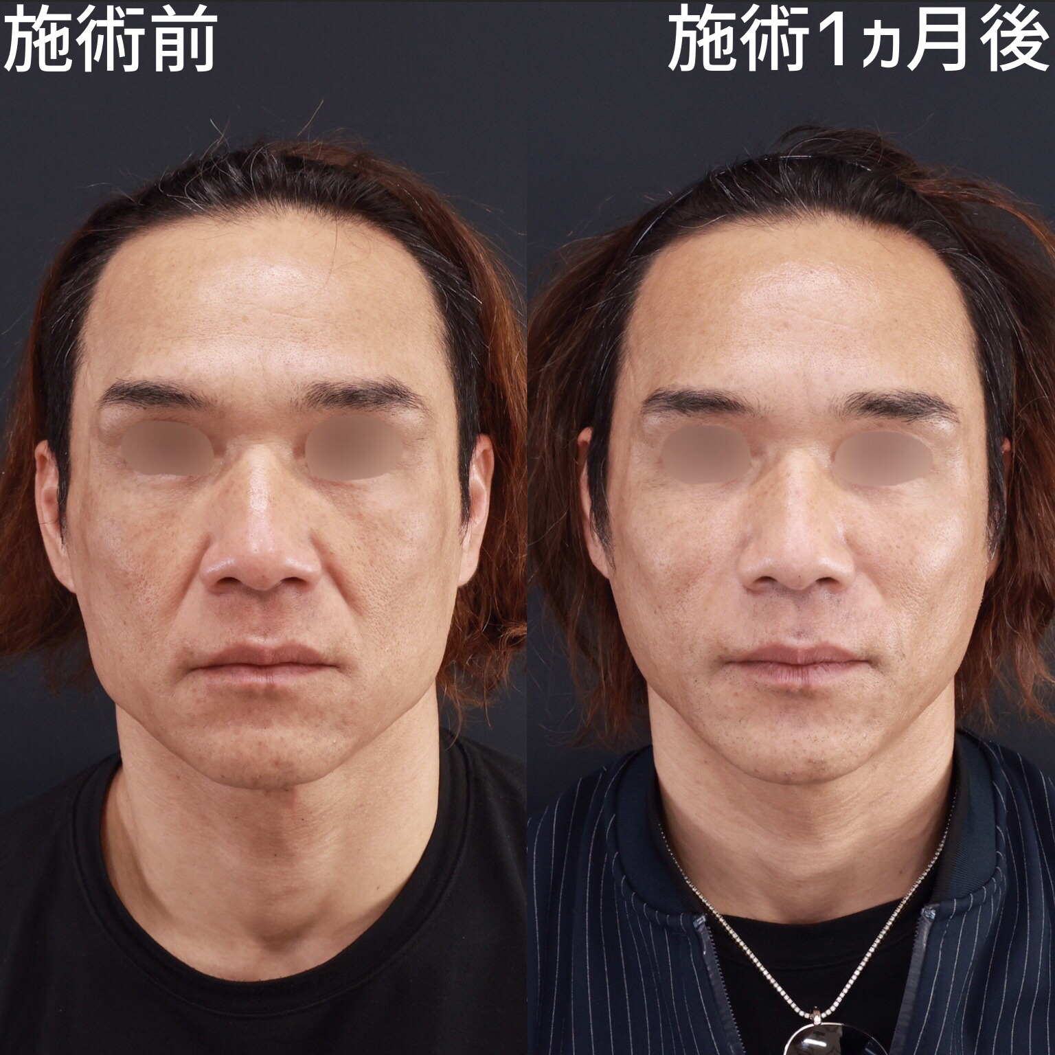 【糸リフト×脂肪注入】小顔整形で若々しい印象に！