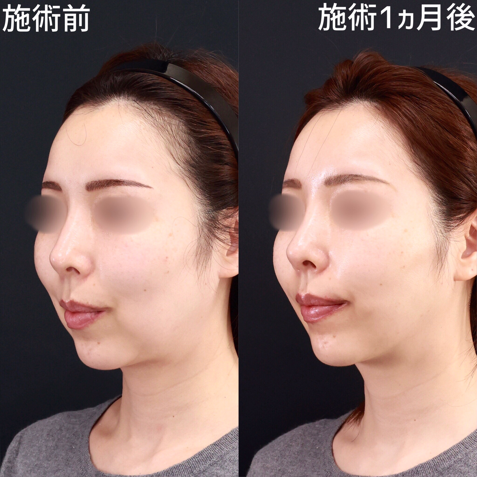 【糸リフト×ジョールファット除去】口元のもたつきをスッキリ改善！