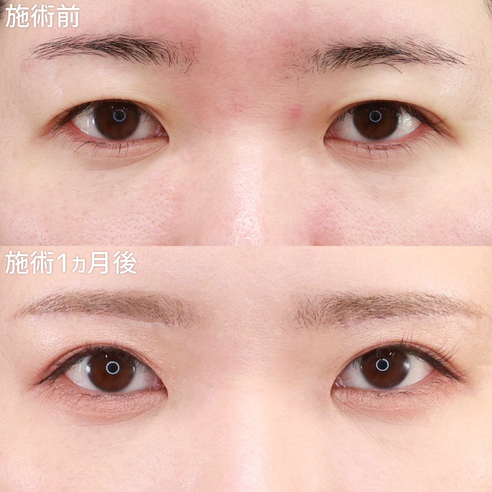 【眉毛下切開術】上瞼のたるみを改善することで、本来の二重ラインが出現！