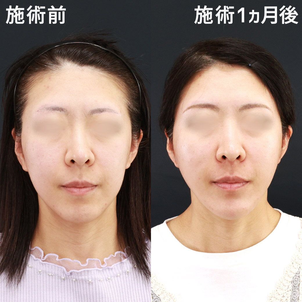 小顔整形｜パーフェクトフェイスライン/ジョールファット除去/顎のヒアルロン酸注射の症例写真 施術前後 