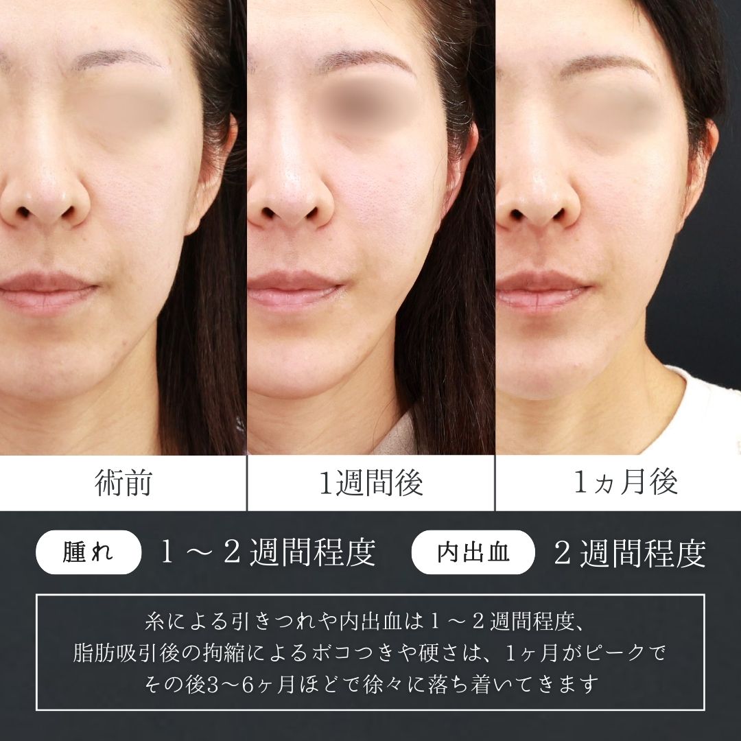 小顔整形｜パーフェクトフェイスライン/ジョールファット除去/顎のヒアルロン酸注射の症例写真 施術前後 