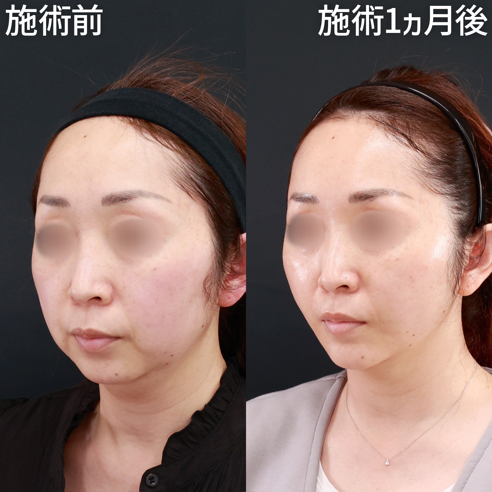 【糸リフト＆脂肪吸引】口周りスッキリ！マイナス5歳の若返り術