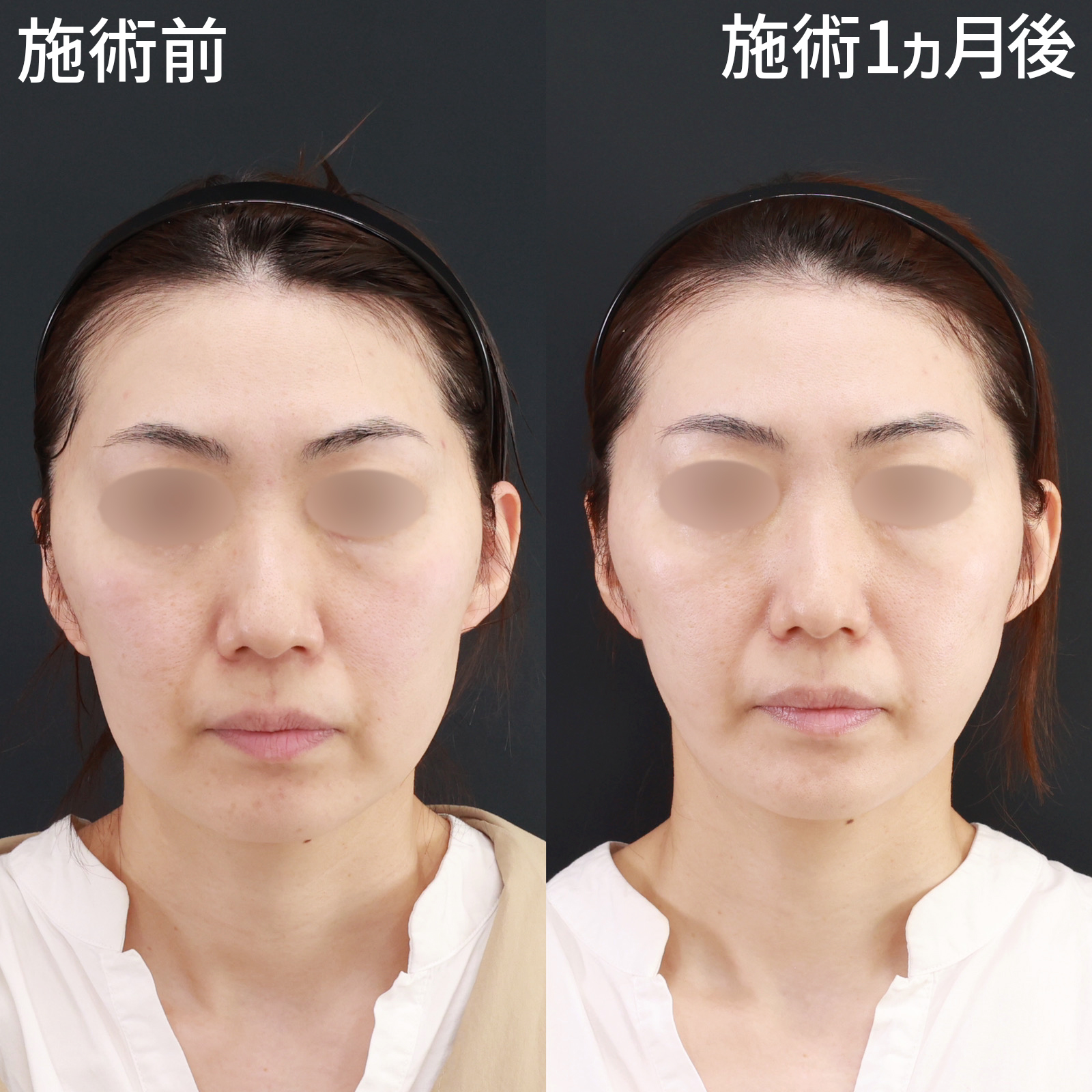 【糸リフト＆脂肪除去】ナチュラルにお顔全体がスッキリ！