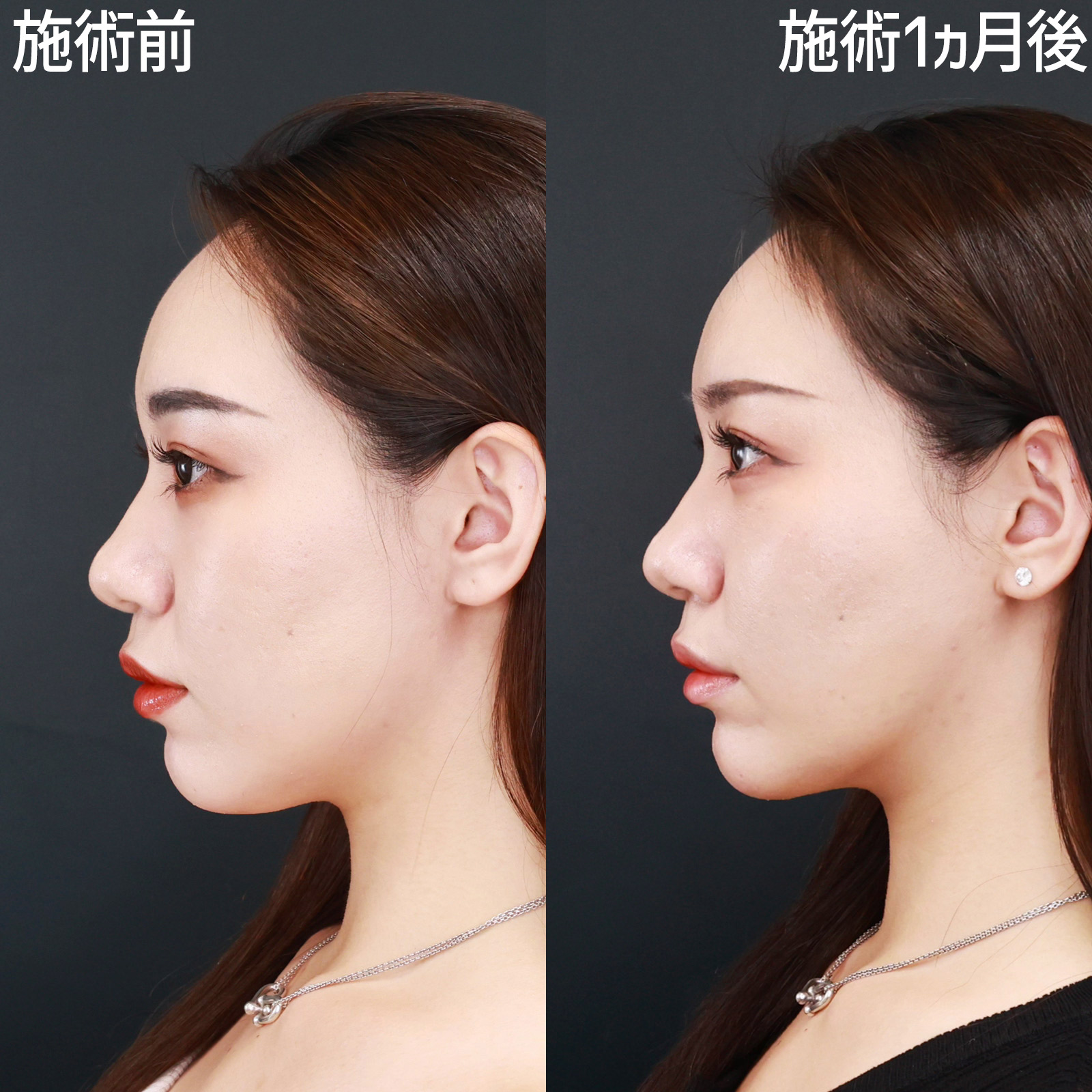 TAC式 ツヤ肌コラーゲンリフト®/顎下の脂肪吸引/Lラインファット除去（エラ下脂肪除去）の症例写真 施術前後 
