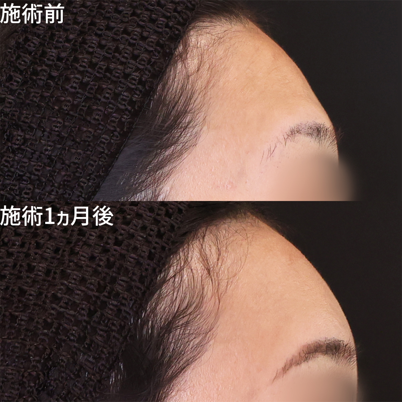 額のシワ、凹凸を解消する「脂肪注入術」！