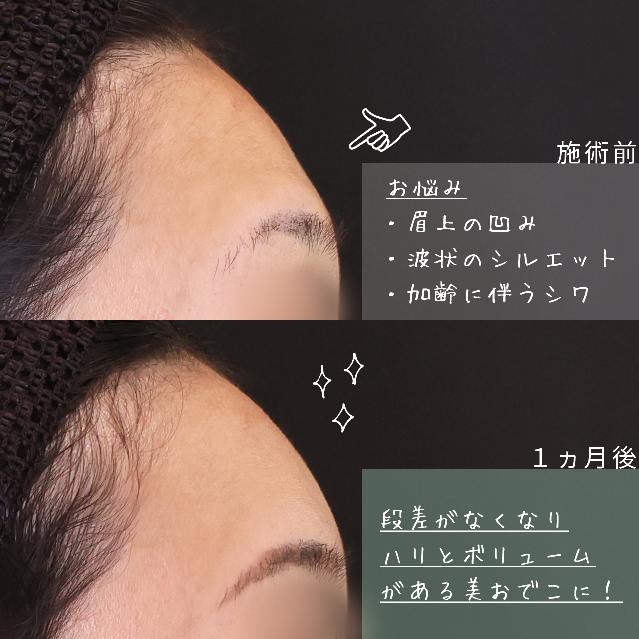 おでこの脂肪注入（オルチャンデコ形成）の症例写真 施術前後 