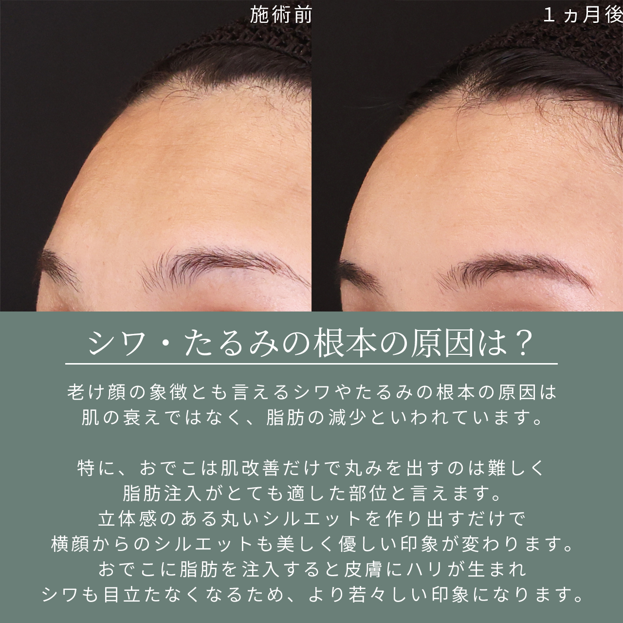 おでこの脂肪注入（オルチャンデコ形成）の症例写真 施術前後 