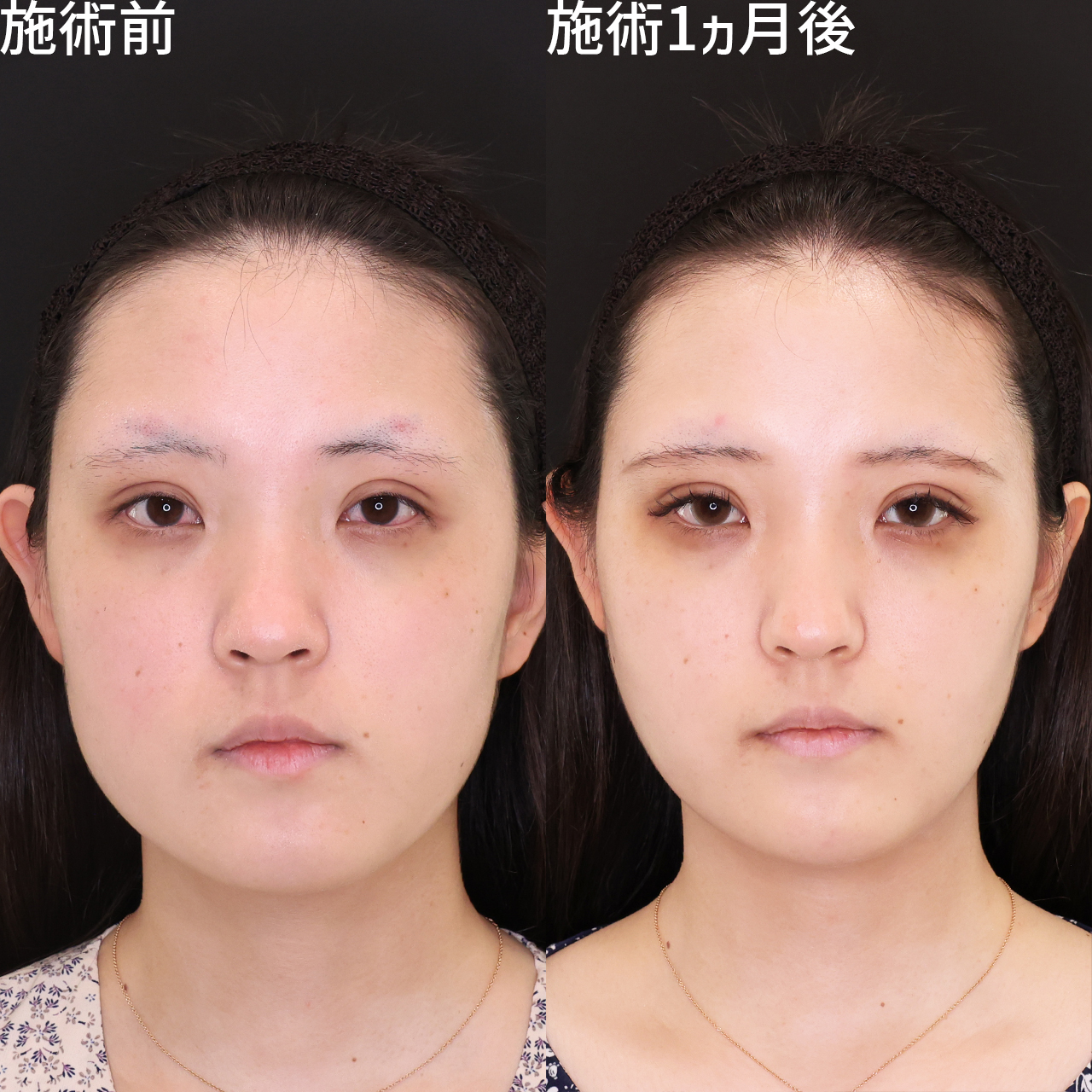 「なんか綺麗になった?」印象を変える小顔術【パーフェクトフェイスライン】