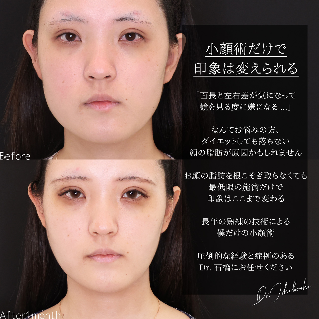 小顔整形｜パーフェクトフェイスライン/TAC式 ツヤ肌コラーゲンリフト®/ジョールファット除去の症例写真 施術前後 