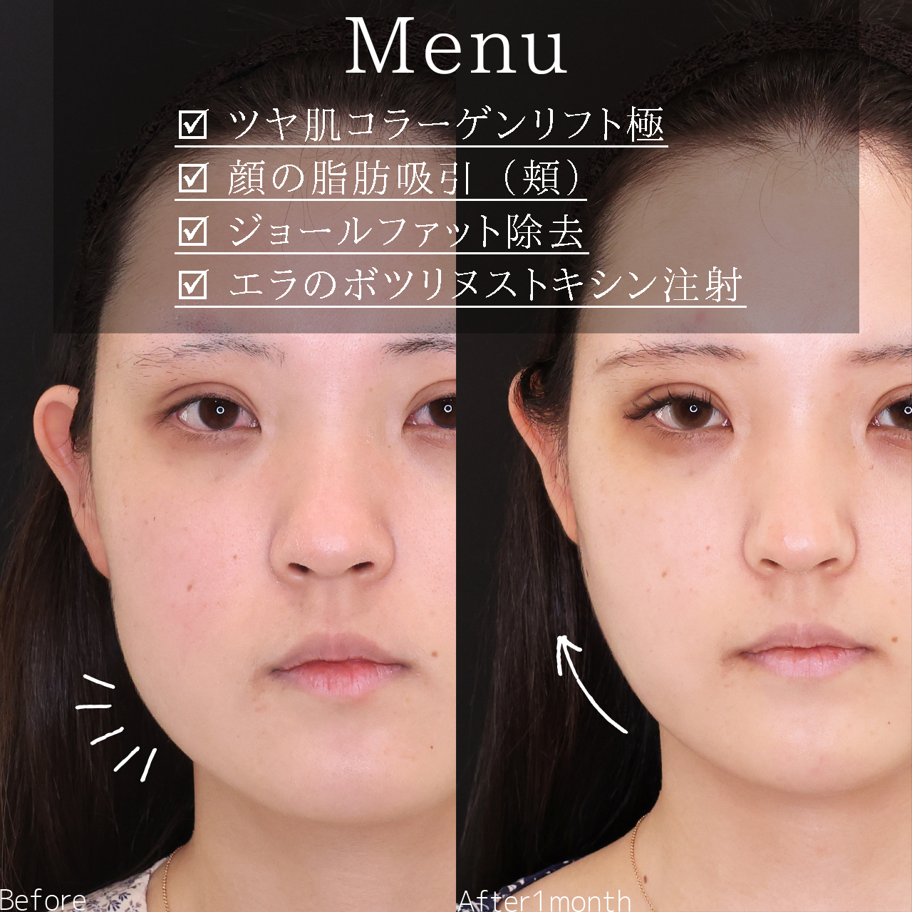 小顔整形｜パーフェクトフェイスライン/TAC式 ツヤ肌コラーゲンリフト®/ジョールファット除去の症例写真 施術前後 