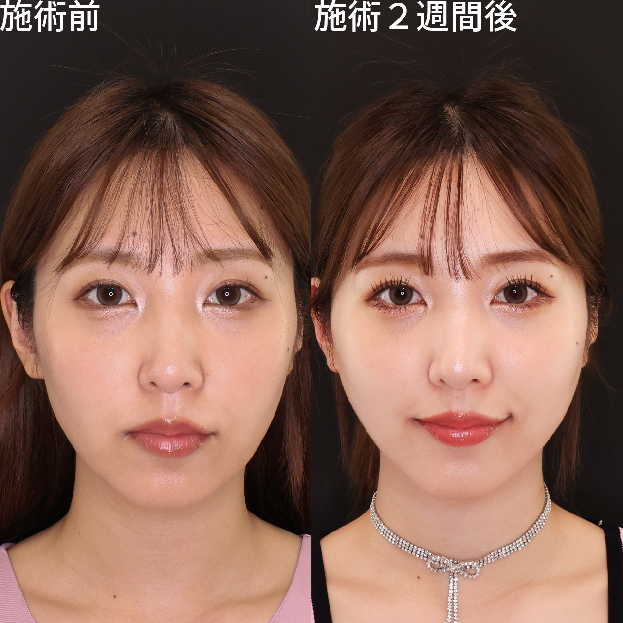 たった15分でリフトアップ！アイドル級小顔術