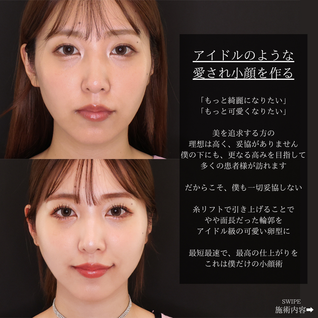 TAC式 ツヤ肌コラーゲンリフト®の症例写真 施術前後 