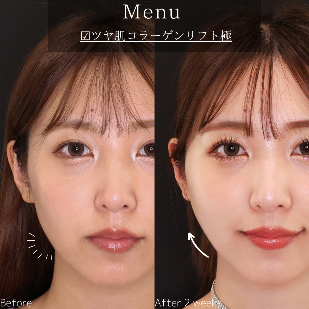 TAC式 ツヤ肌コラーゲンリフト®の症例写真 施術前後 