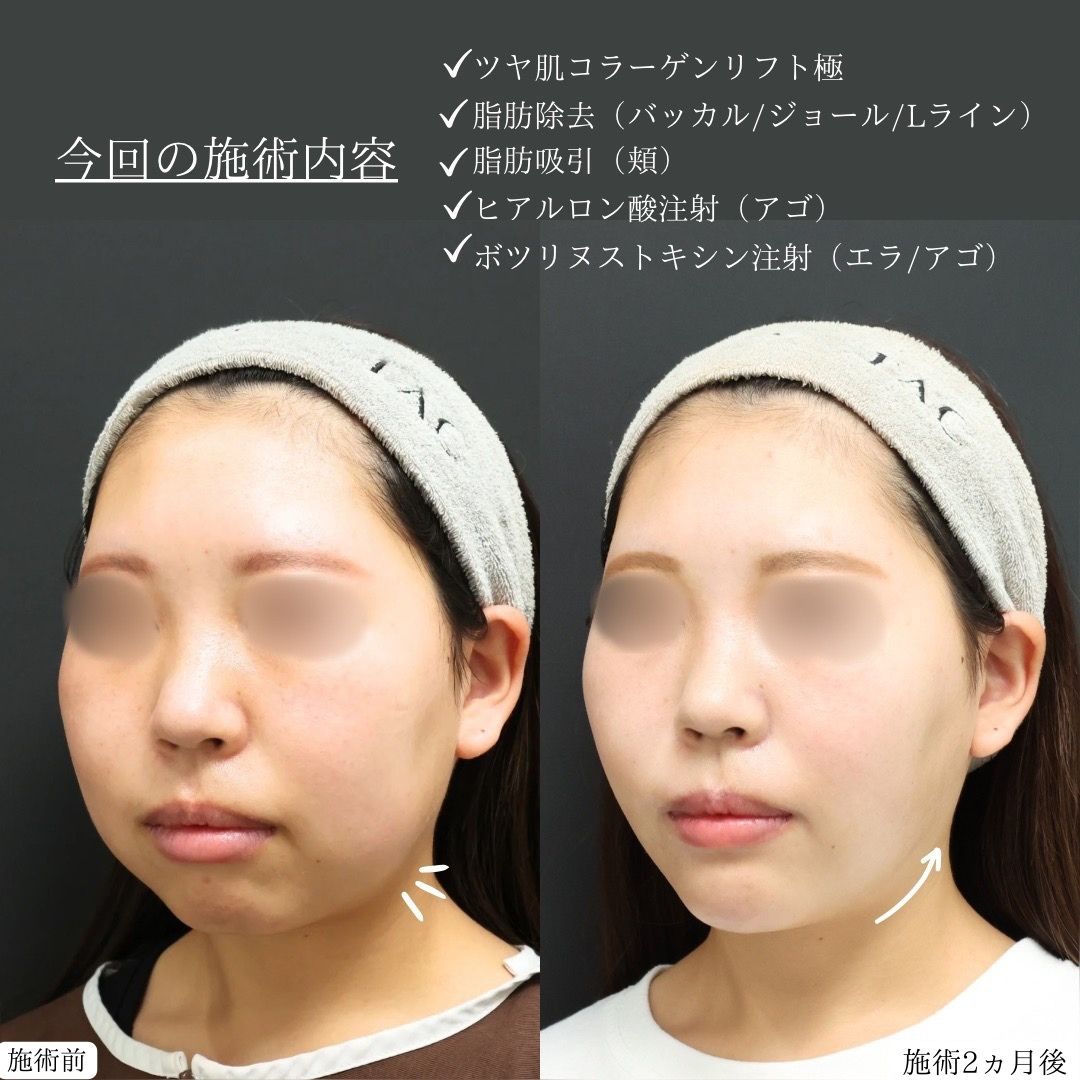 TAC式 ツヤ肌コラーゲンリフト®/ジョールファット除去/バッカルファット除去の症例写真 施術前後 