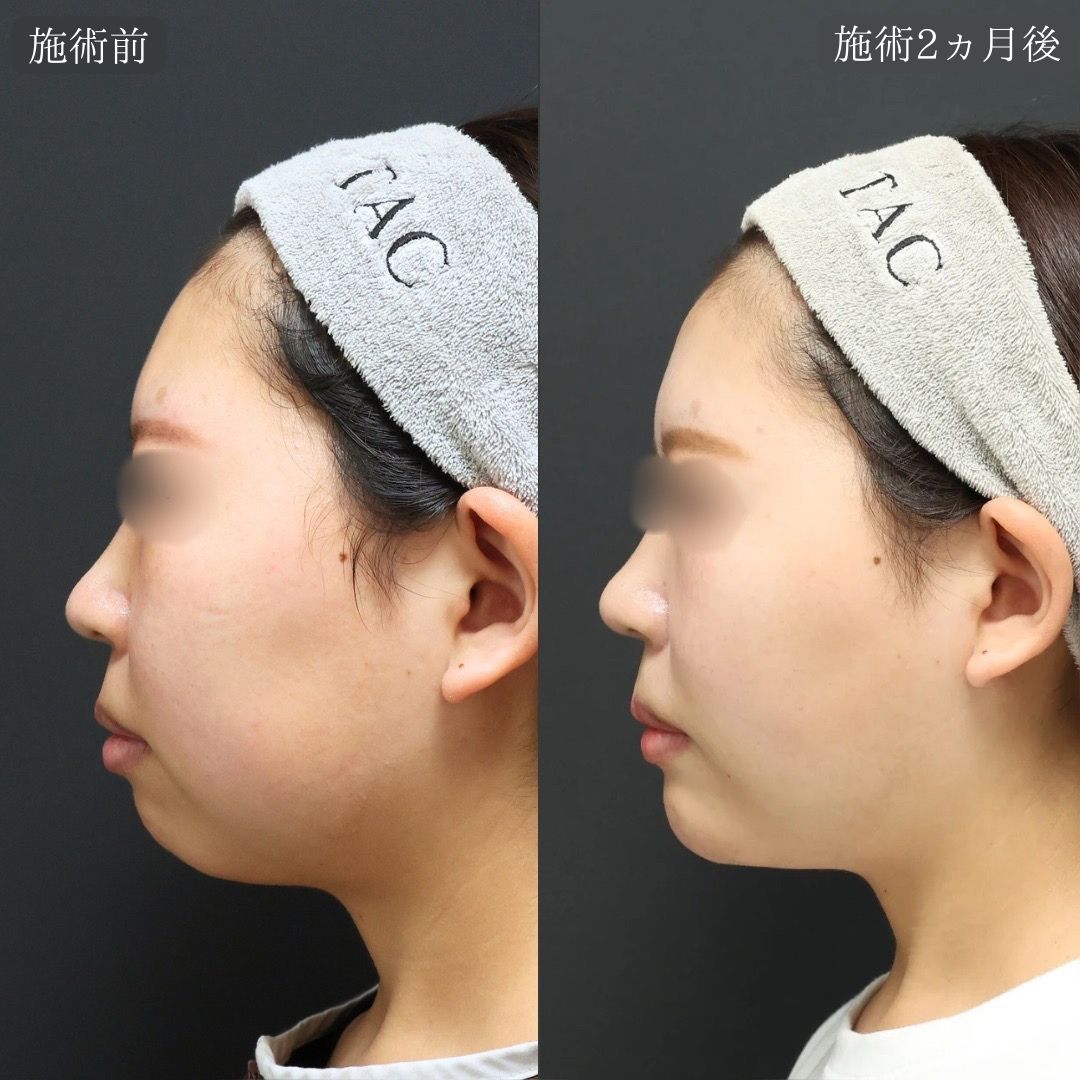 TAC式 ツヤ肌コラーゲンリフト®/ジョールファット除去/バッカルファット除去の症例写真 施術前後 