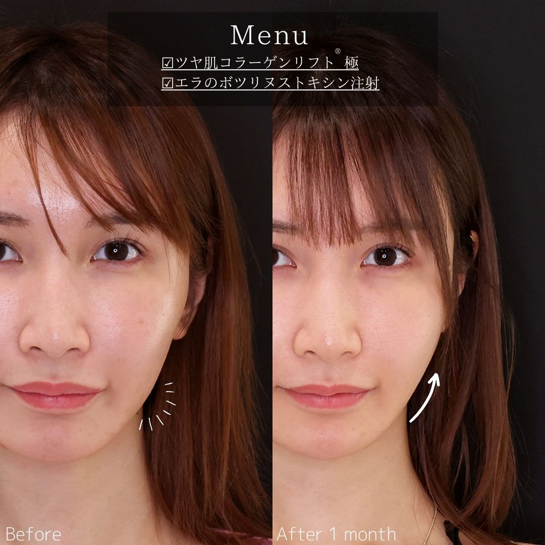 TAC式 ツヤ肌コラーゲンリフト®/エラボトックス注射の症例写真 施術前後 