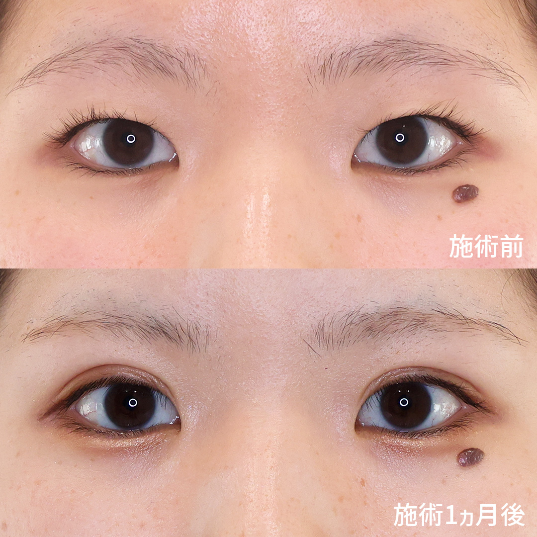 もうアイプチに頼らない！【二重埋没法】でくりっと可愛いお目元に！