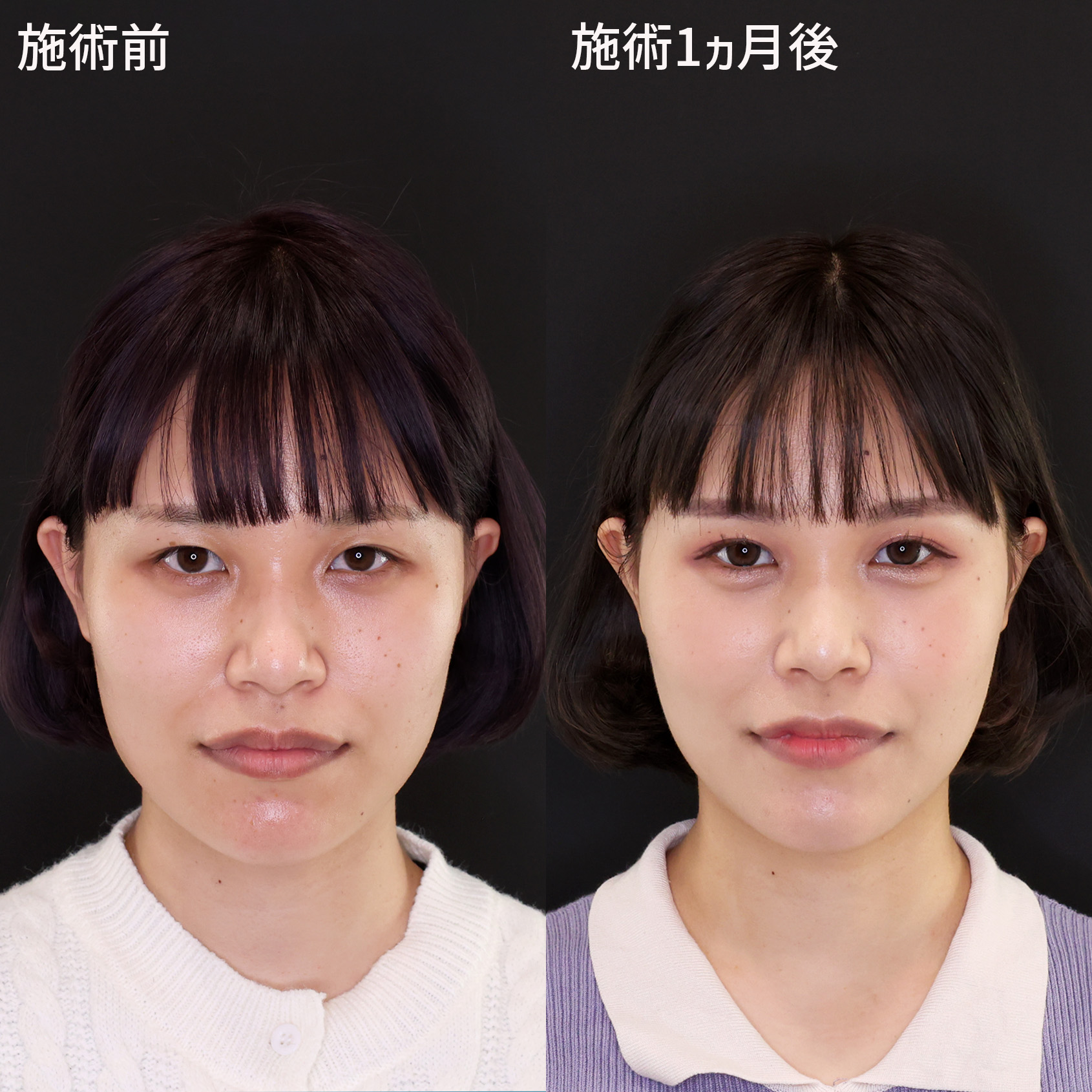 【二重埋没+糸リフト】で圧倒的に可愛くアップデート!