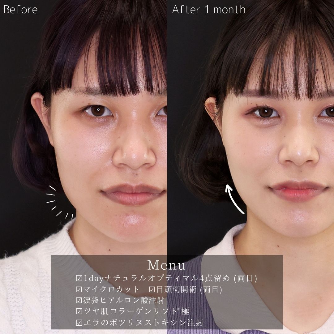 二重埋没法/目頭切開術/涙袋形成（ヒアルロン酸注射）の症例写真 施術前後 