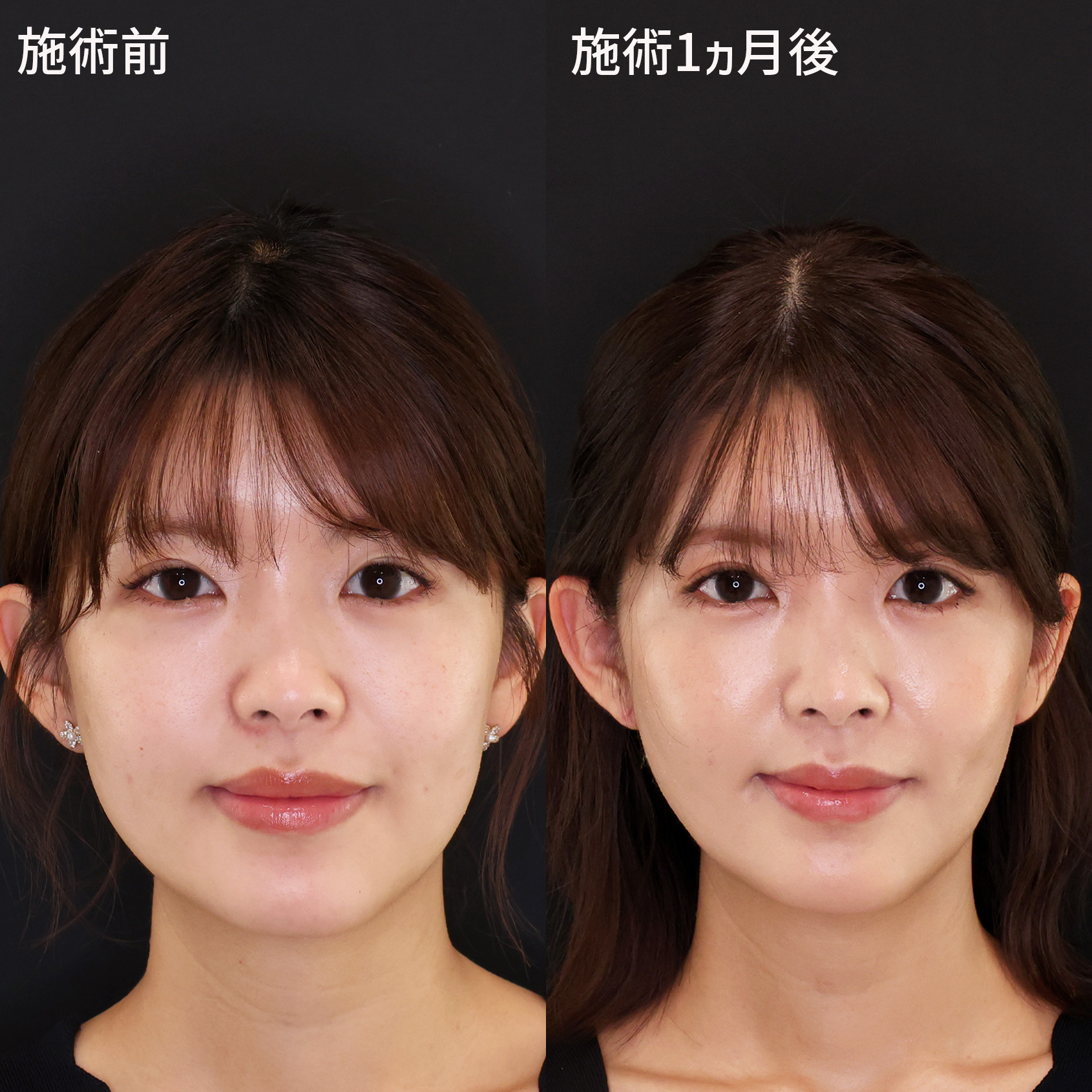 【糸リフト＋脂肪除去】で叶う、理想の美しい輪郭へ！